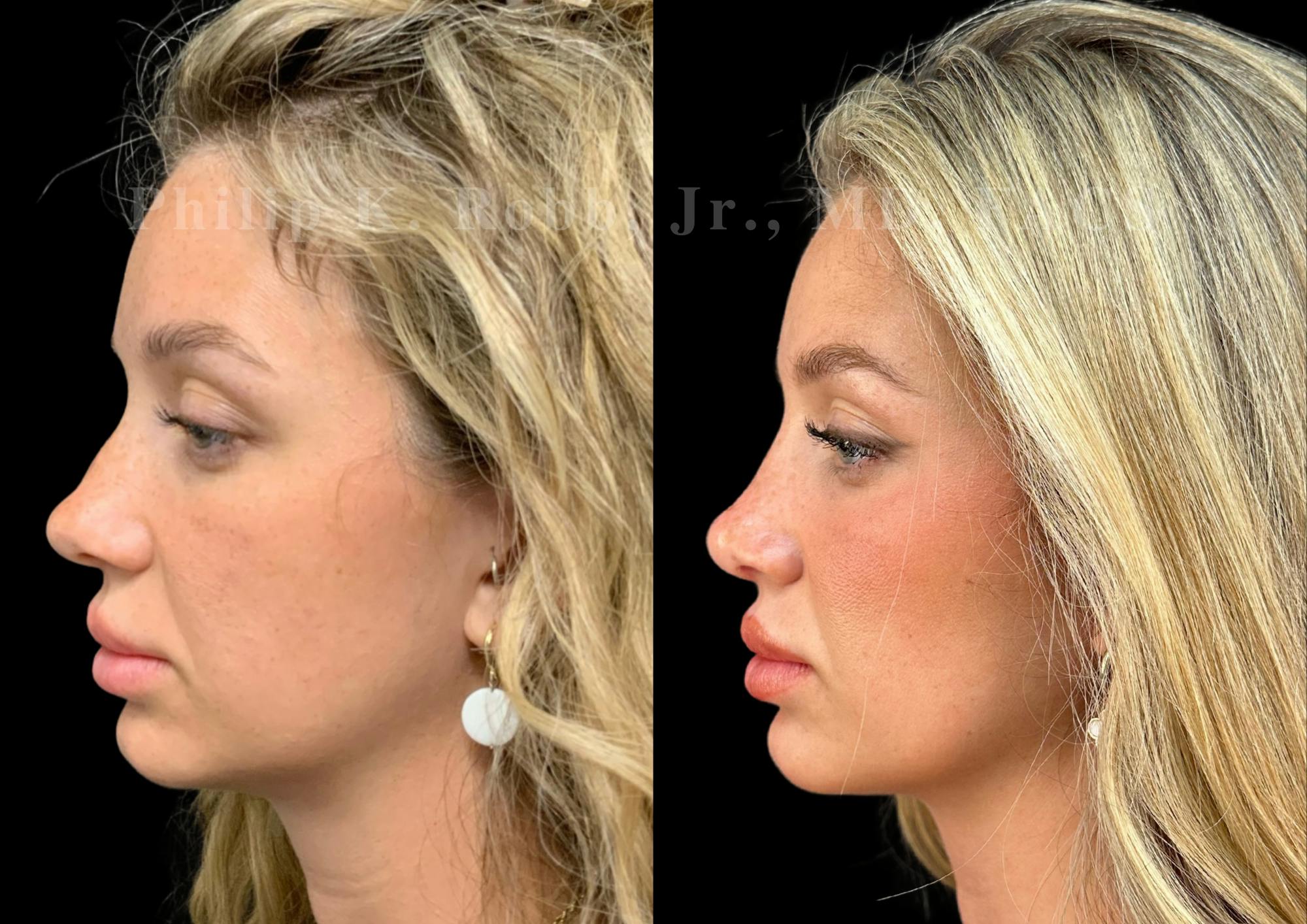 Ultrasonic Rhinoplasty Before & After Gallery - Patient 373935 - Image 5