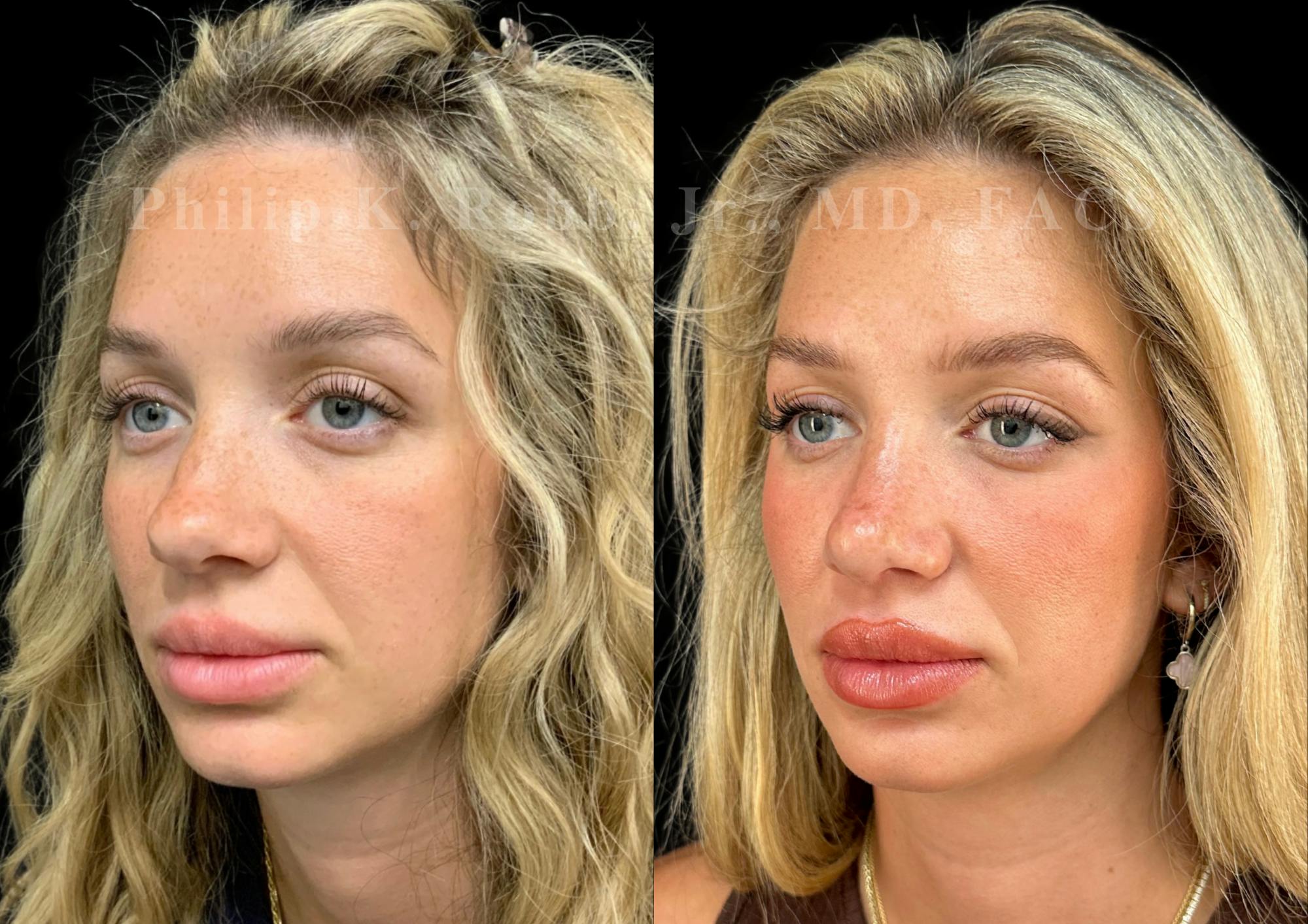 Ultrasonic Rhinoplasty Before & After Gallery - Patient 373935 - Image 4