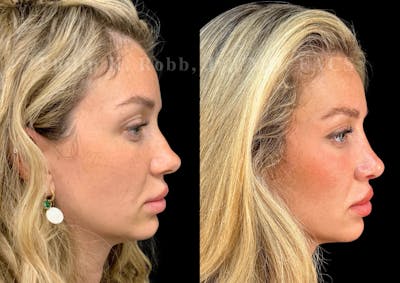 Ultrasonic Rhinoplasty Before & After Gallery - Patient 373935 - Image 1