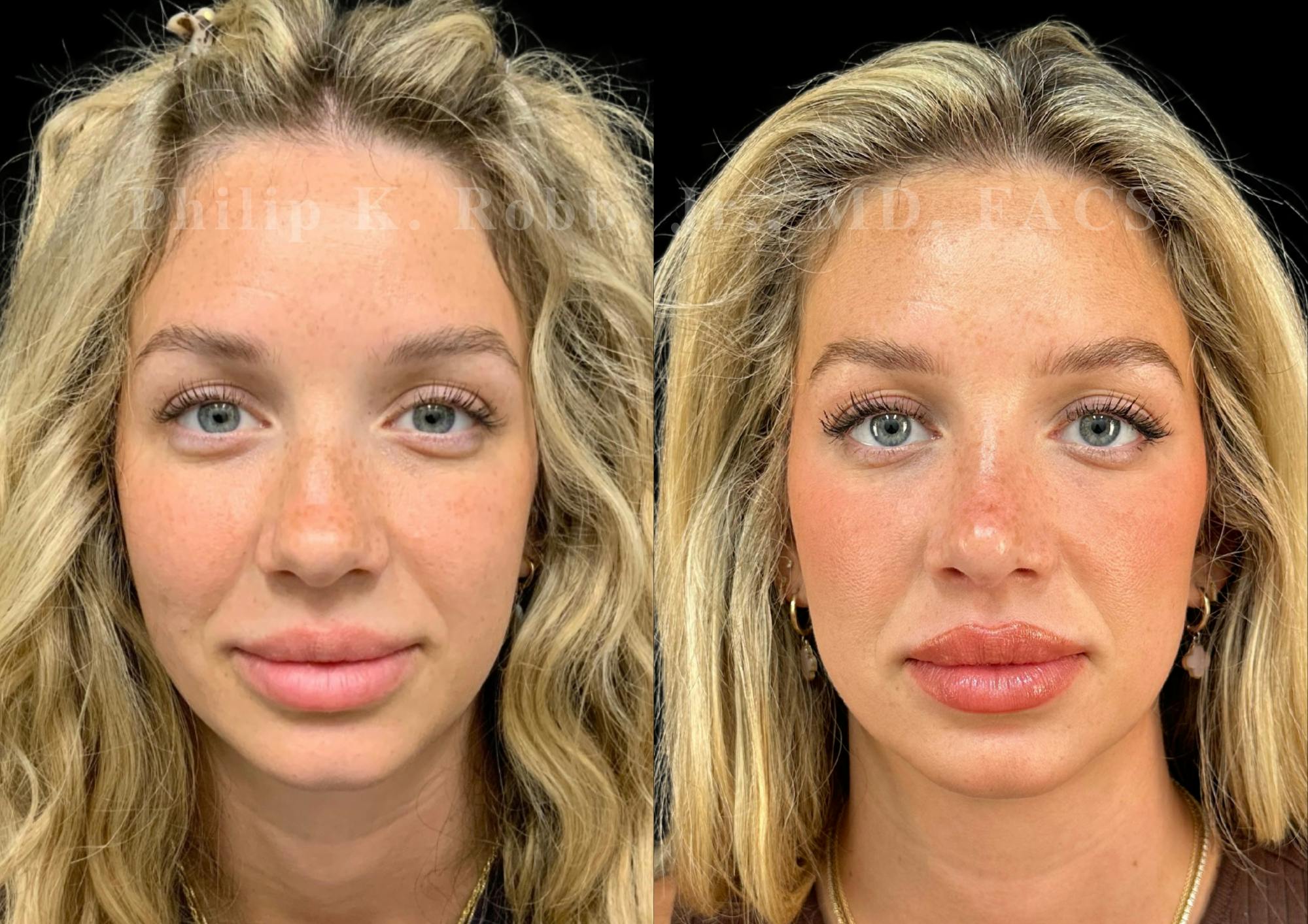 Ultrasonic Rhinoplasty Before & After Gallery - Patient 373935 - Image 3
