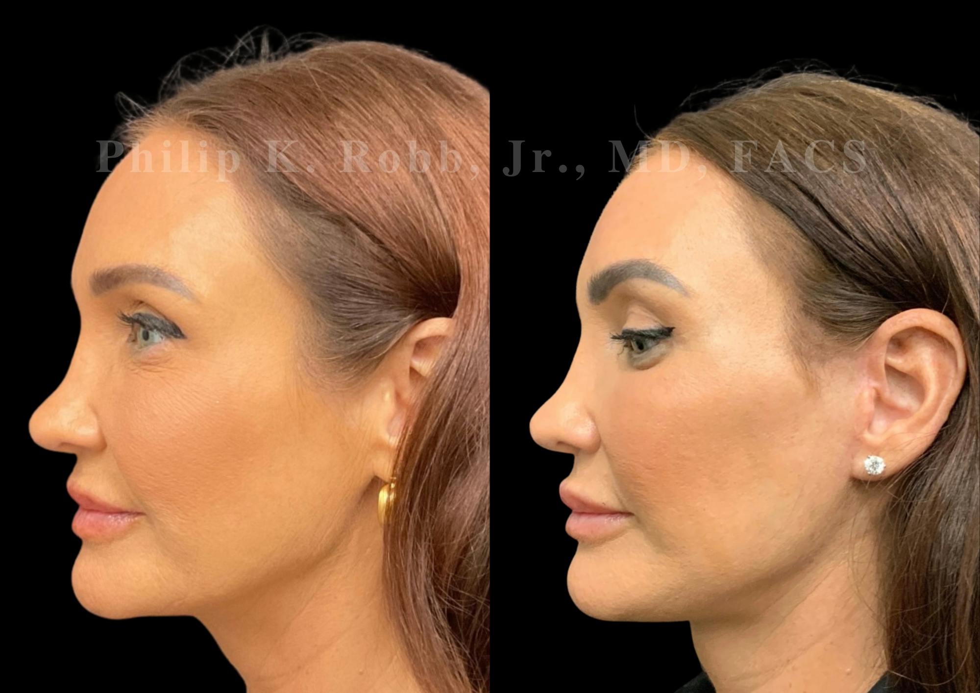 Laser Skin Resurfacing Before & After Gallery - Patient 298792 - Image 3