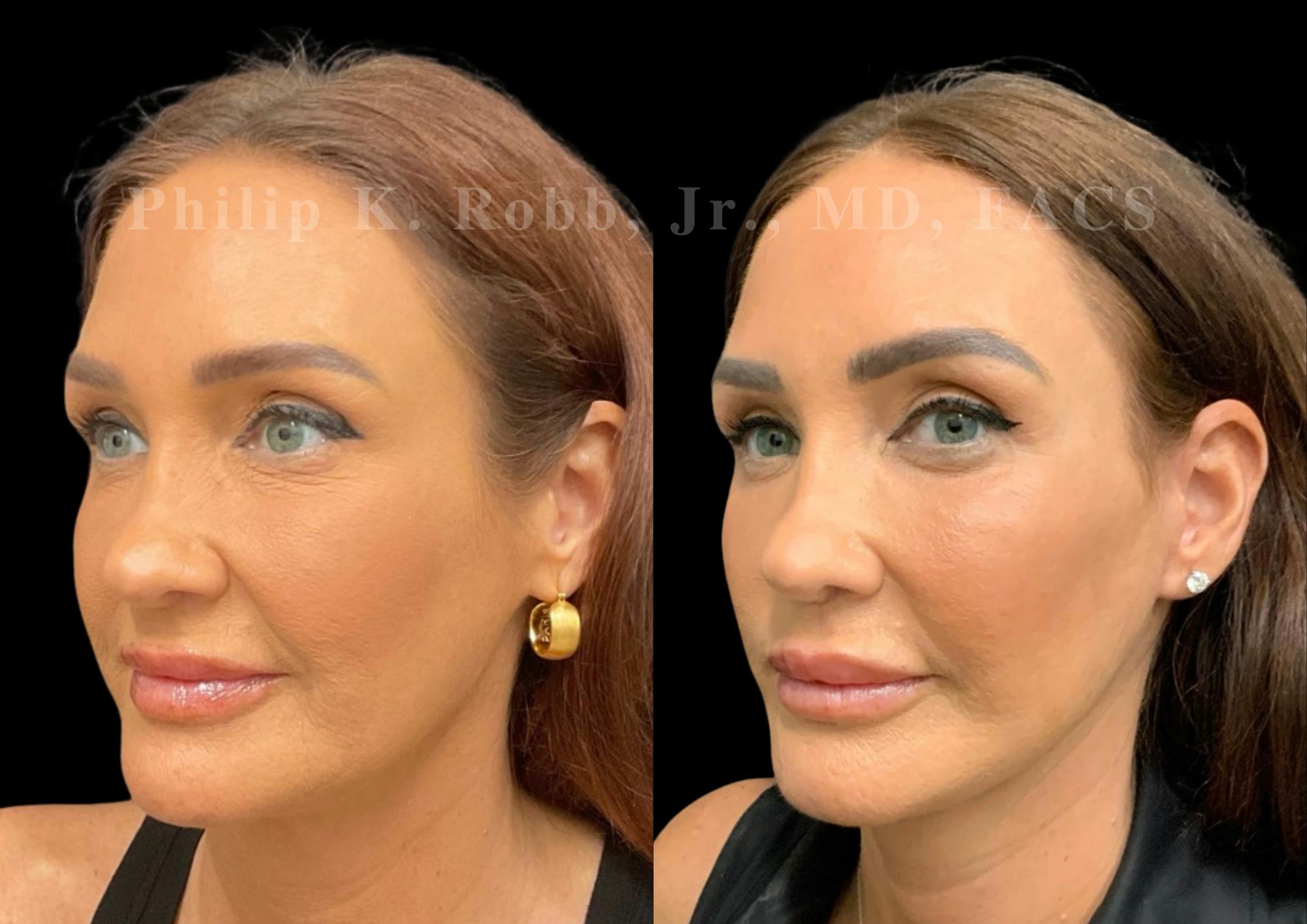 Laser Skin Resurfacing Before & After Gallery - Patient 298792 - Image 4
