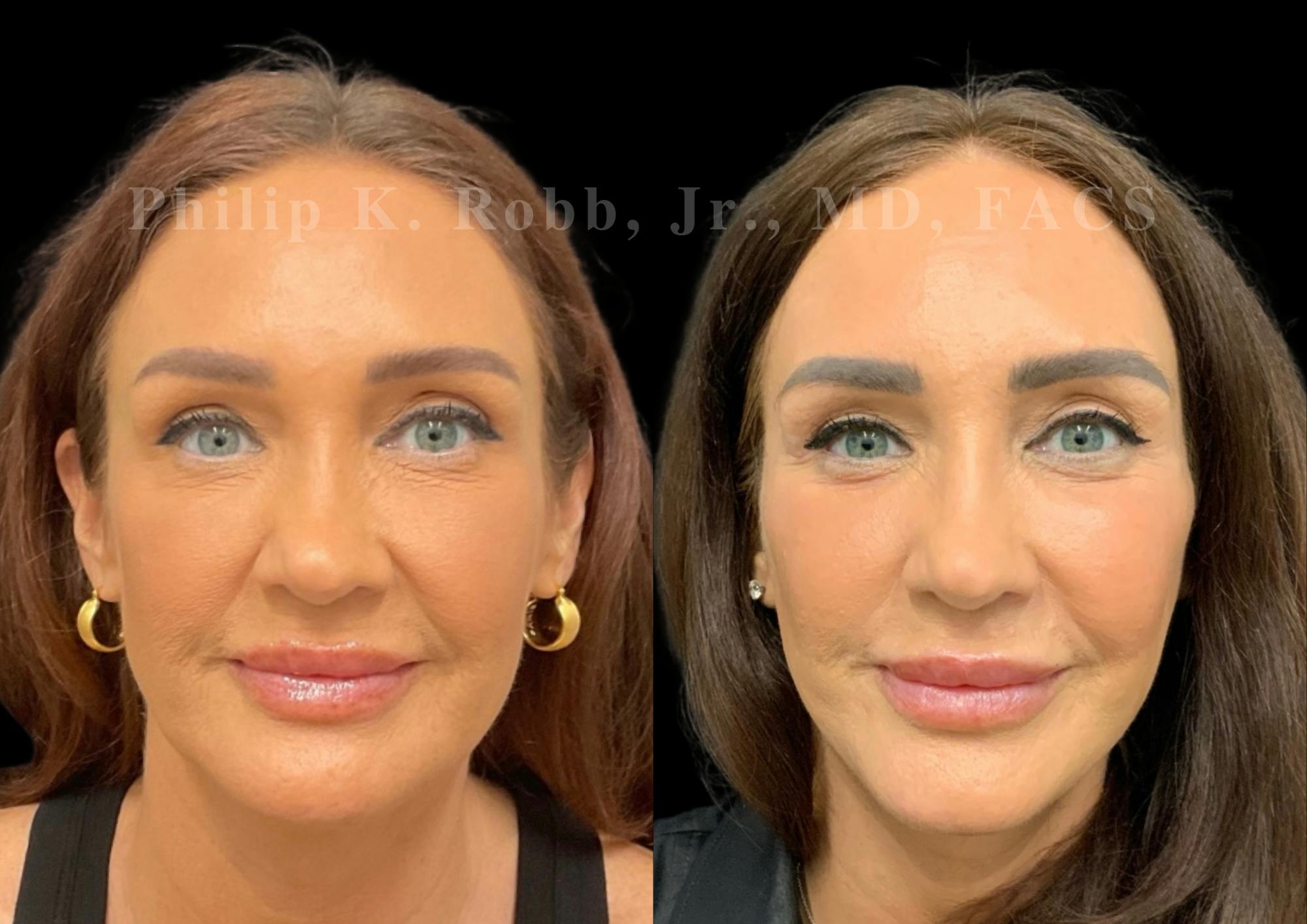 Laser Skin Resurfacing Before & After Gallery - Patient 298792 - Image 1
