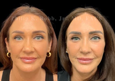 Laser Skin Resurfacing Before & After Gallery - Patient 298792 - Image 1
