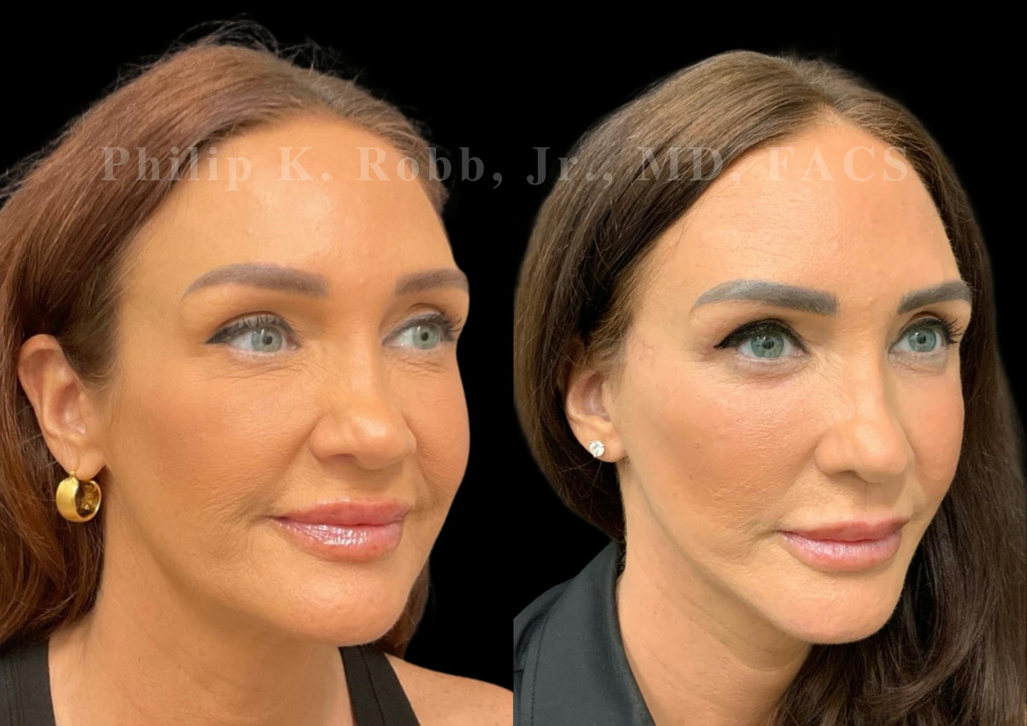 Laser Skin Resurfacing Before & After Gallery - Patient 298792 - Image 5