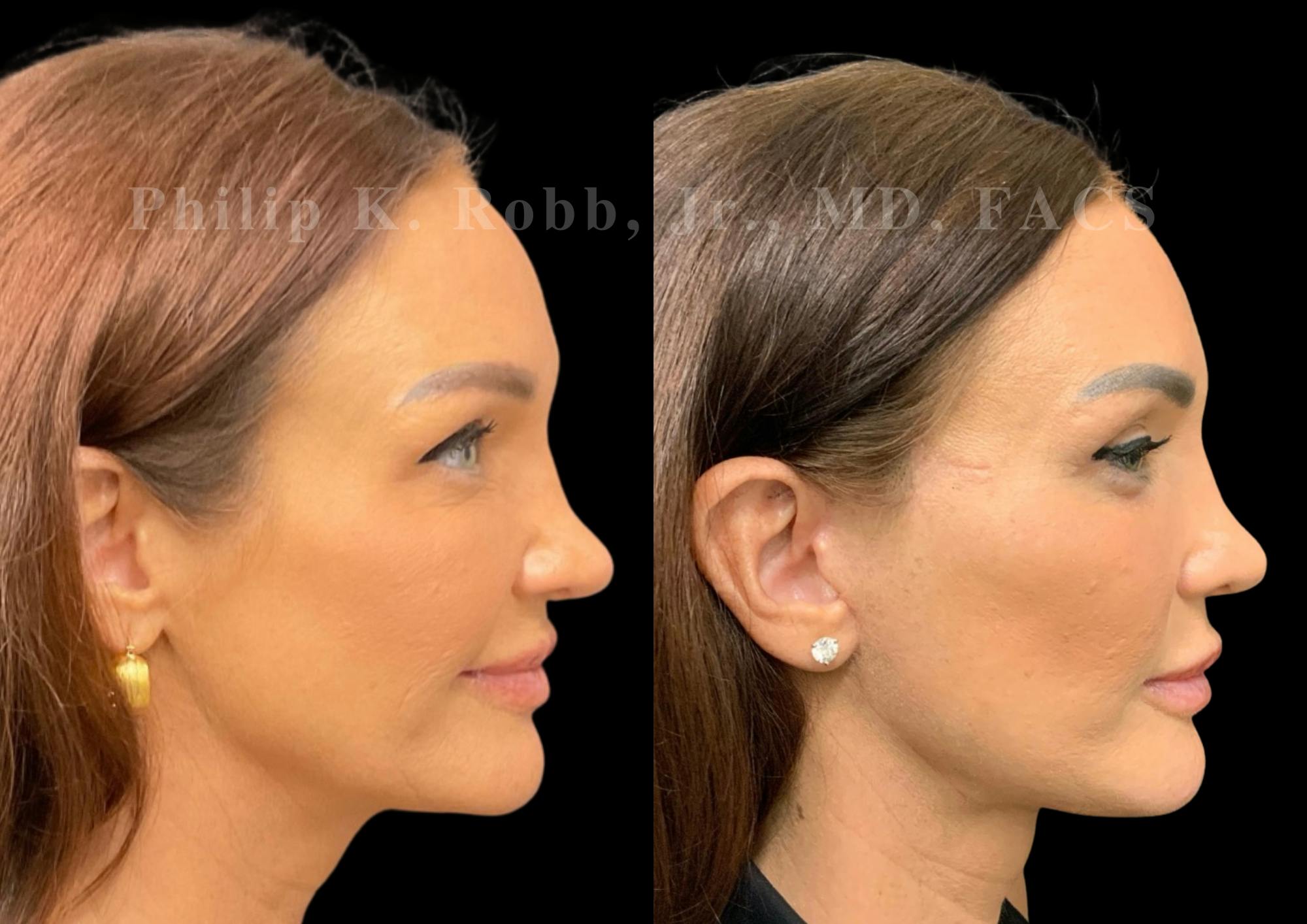 Laser Skin Resurfacing Before & After Gallery - Patient 298792 - Image 6