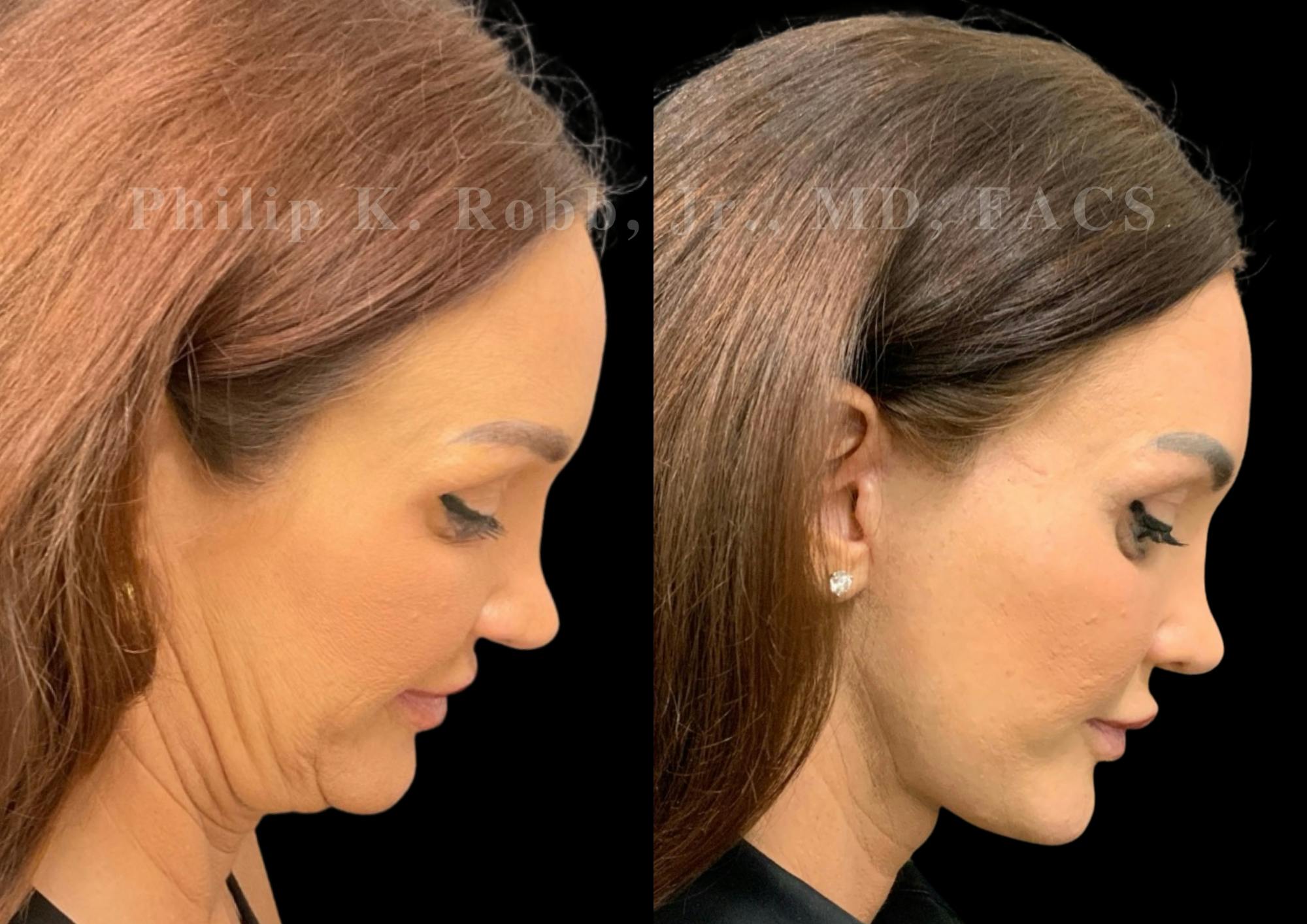Laser Skin Resurfacing Before & After Gallery - Patient 298792 - Image 7