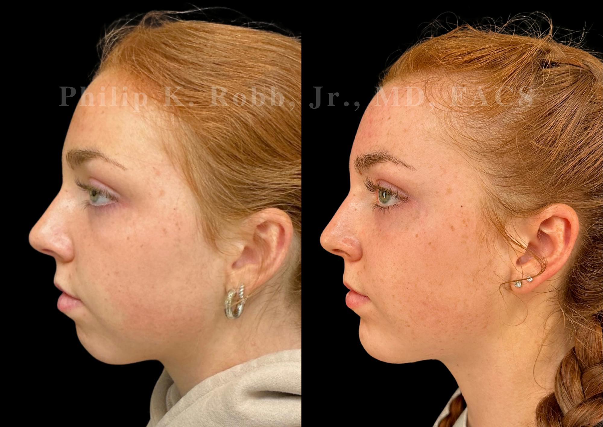 Chin Augmentation Before & After Gallery - Patient 260787 - Image 1