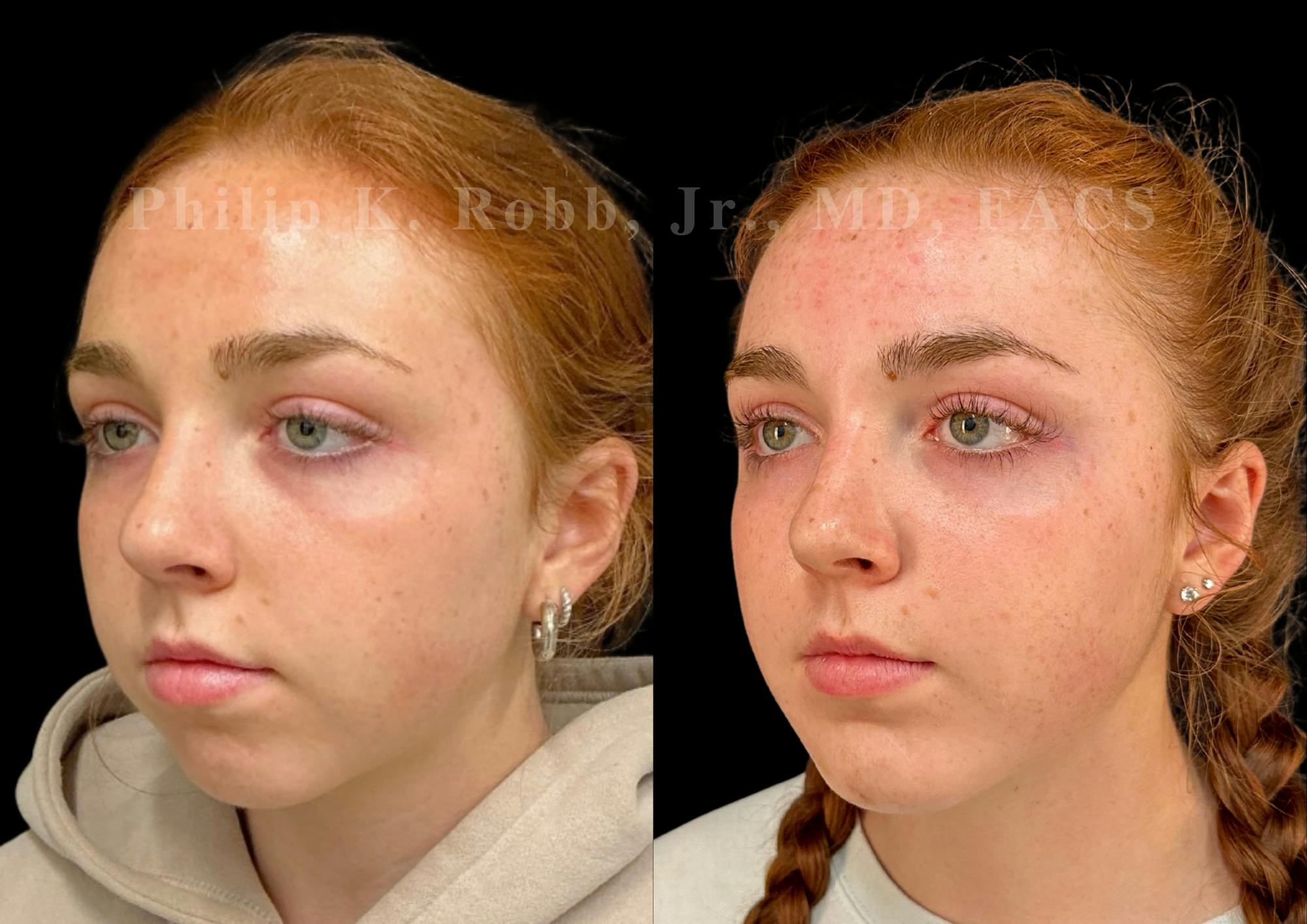 Chin Augmentation Before & After Gallery - Patient 260787 - Image 2