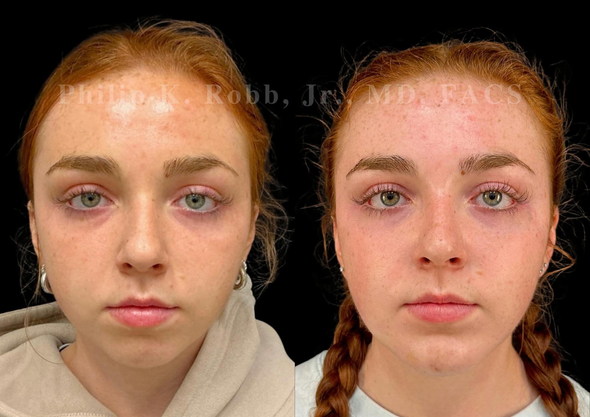 Chin Augmentation Before & After Gallery - Patient 260787 - Image 3