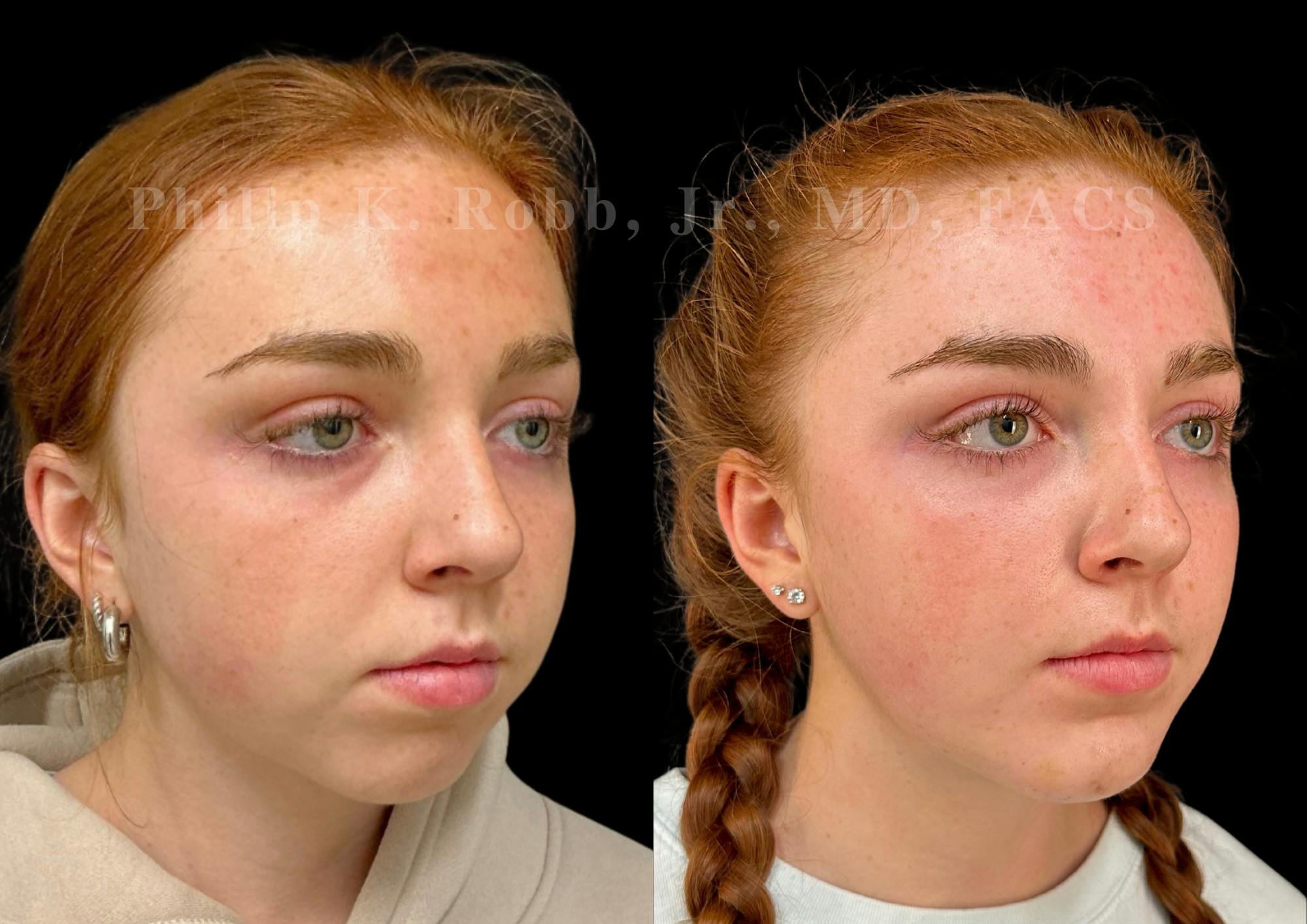 Chin Augmentation Before & After Gallery - Patient 260787 - Image 4