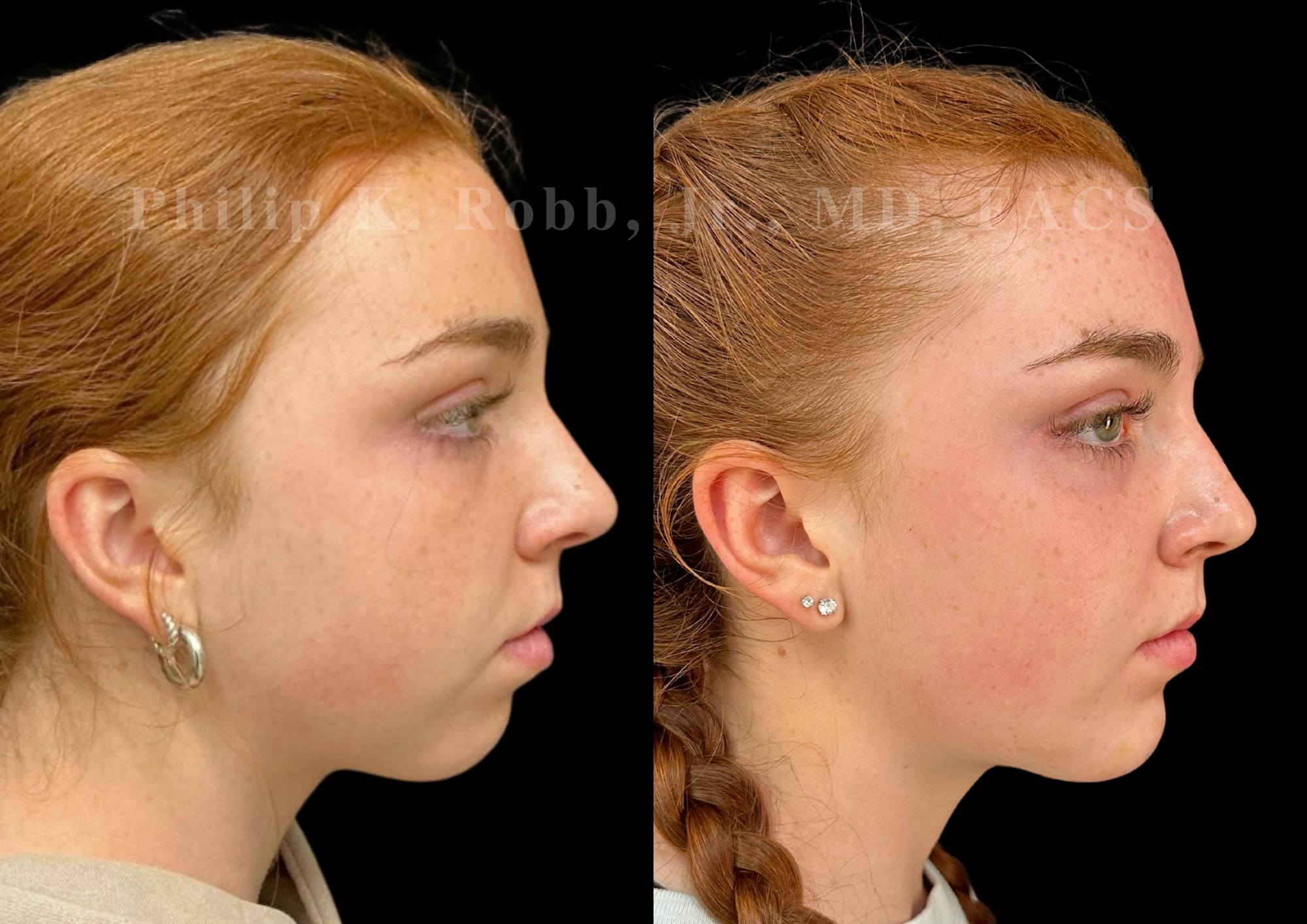 Chin Augmentation Before & After Gallery - Patient 260787 - Image 5