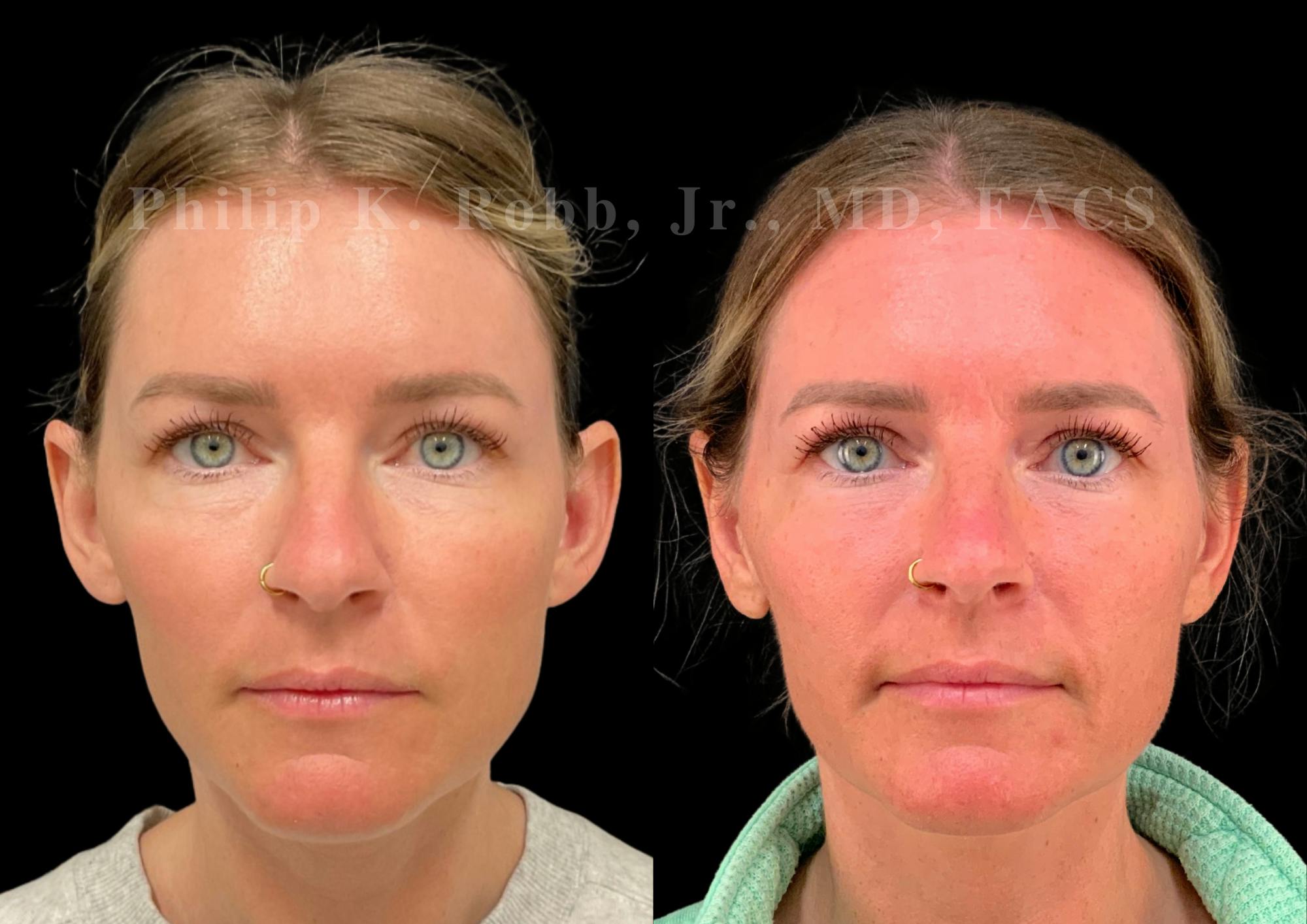 Otoplasty Before & After Gallery - Patient 363443 - Image 1