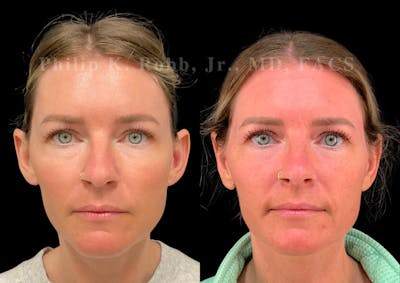 Otoplasty Before & After Gallery - Patient 363443 - Image 1