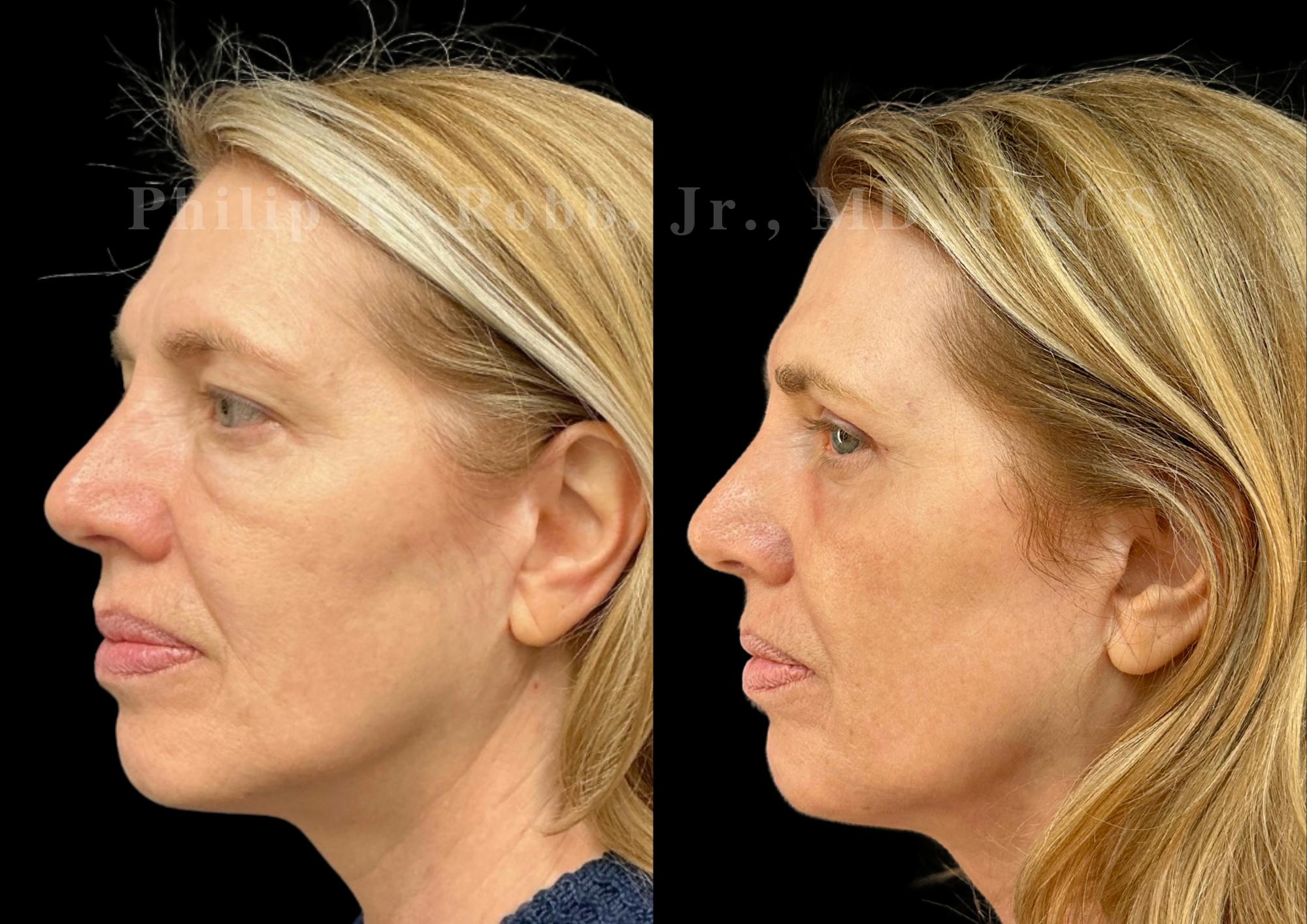 Laser Skin Resurfacing Before & After Gallery - Patient 510694 - Image 2