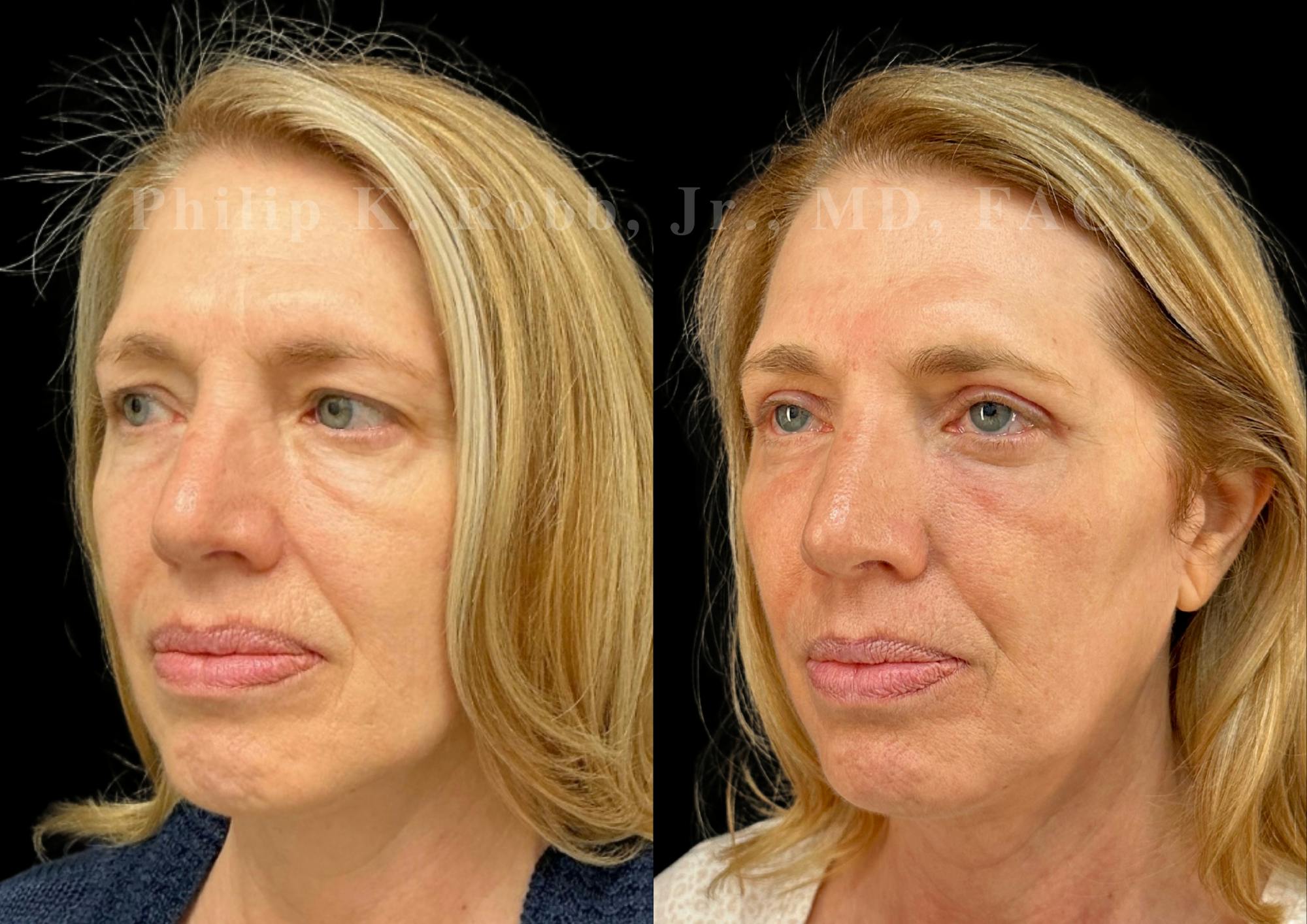 Laser Skin Resurfacing Before & After Gallery - Patient 510694 - Image 3