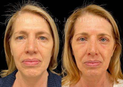 Laser Skin Resurfacing Before & After Gallery - Patient 510694 - Image 1