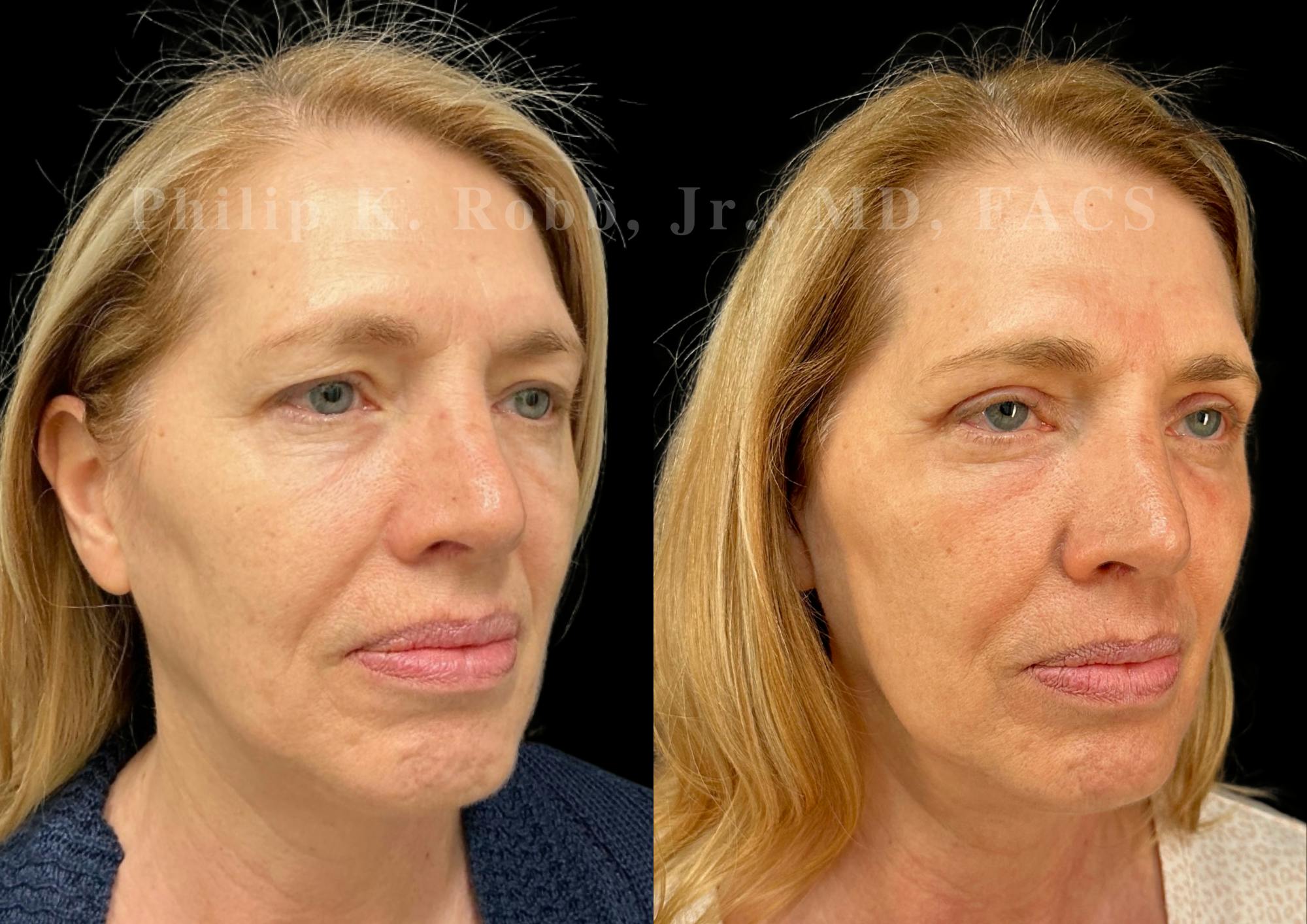 Laser Skin Resurfacing Before & After Gallery - Patient 510694 - Image 4