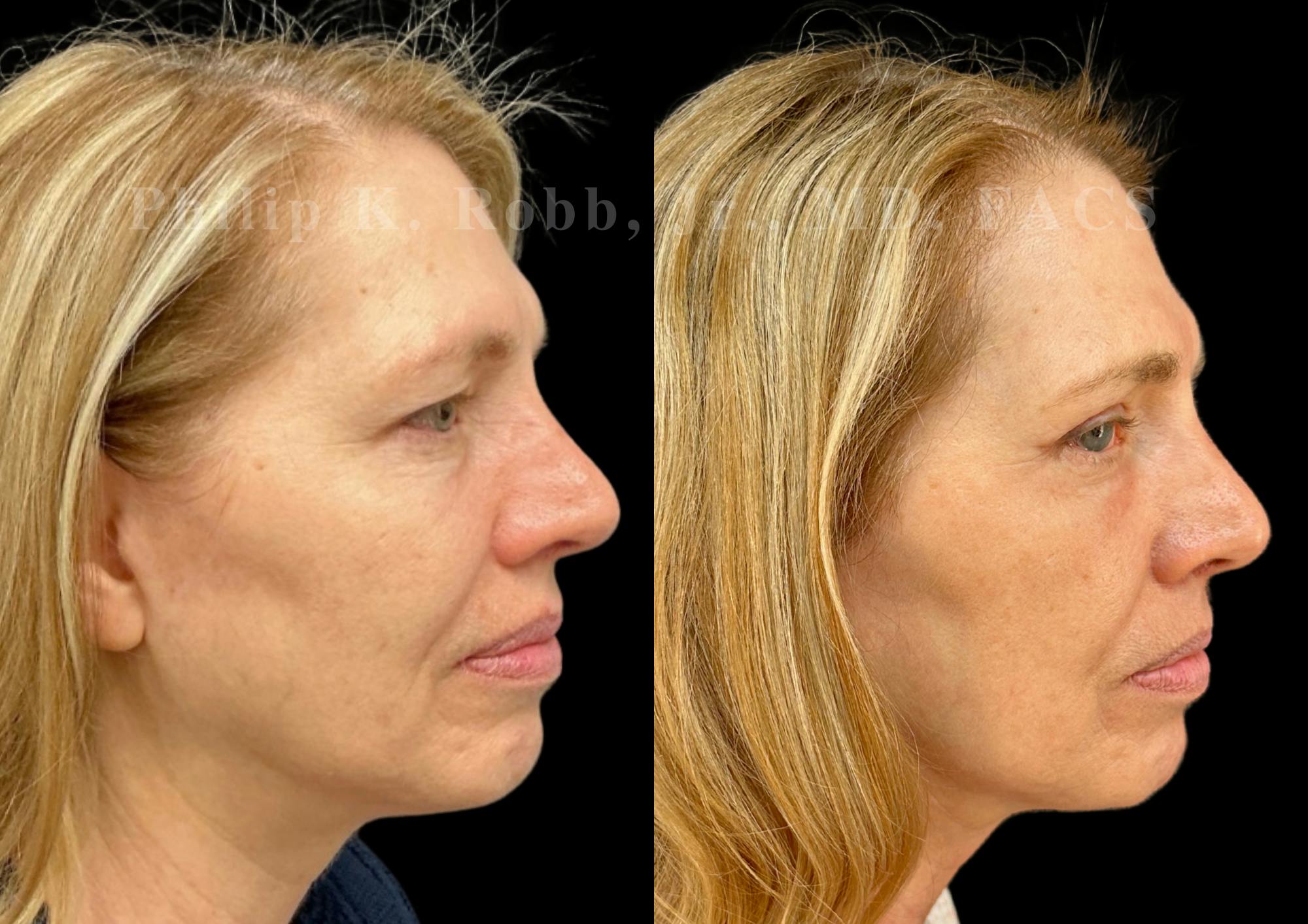 Laser Skin Resurfacing Before & After Gallery - Patient 510694 - Image 5
