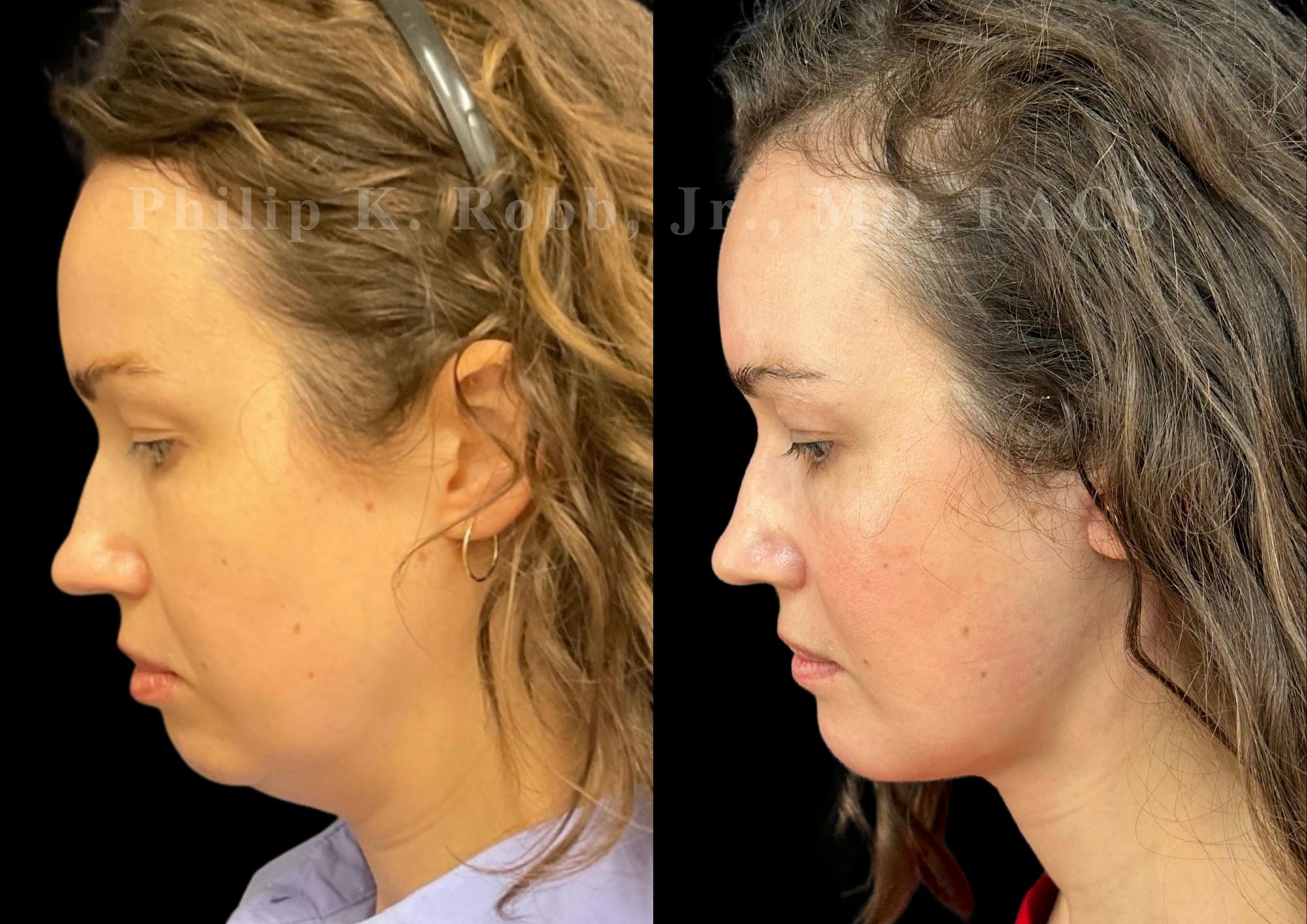 Chin Augmentation Before & After Gallery - Patient 311403 - Image 2