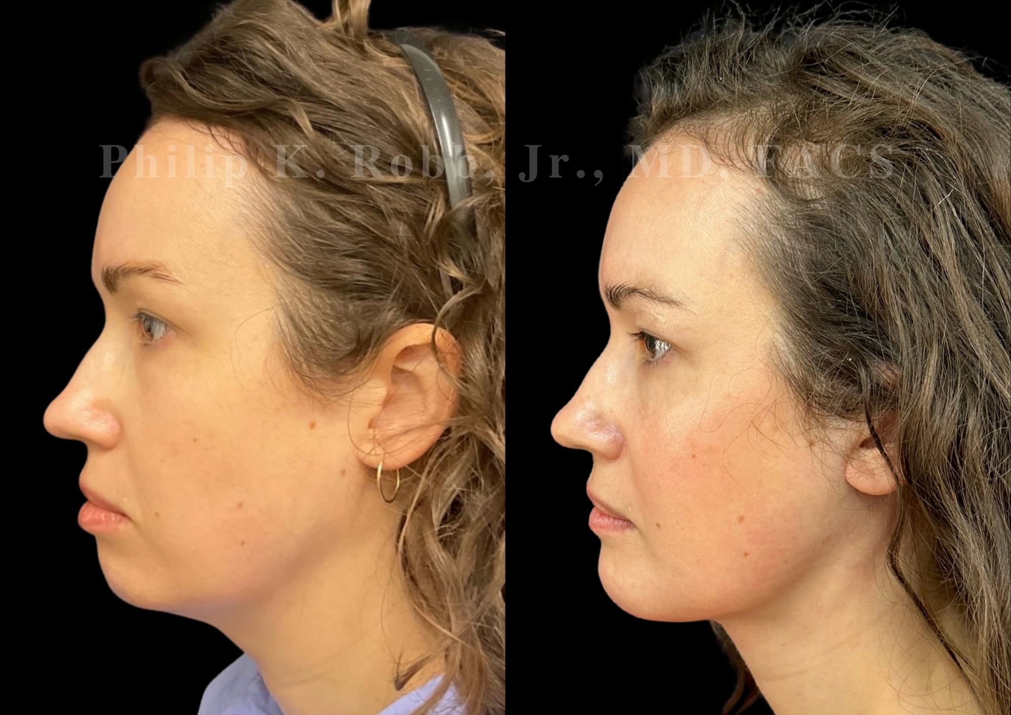 Chin Augmentation Before & After Gallery - Patient 311403 - Image 1