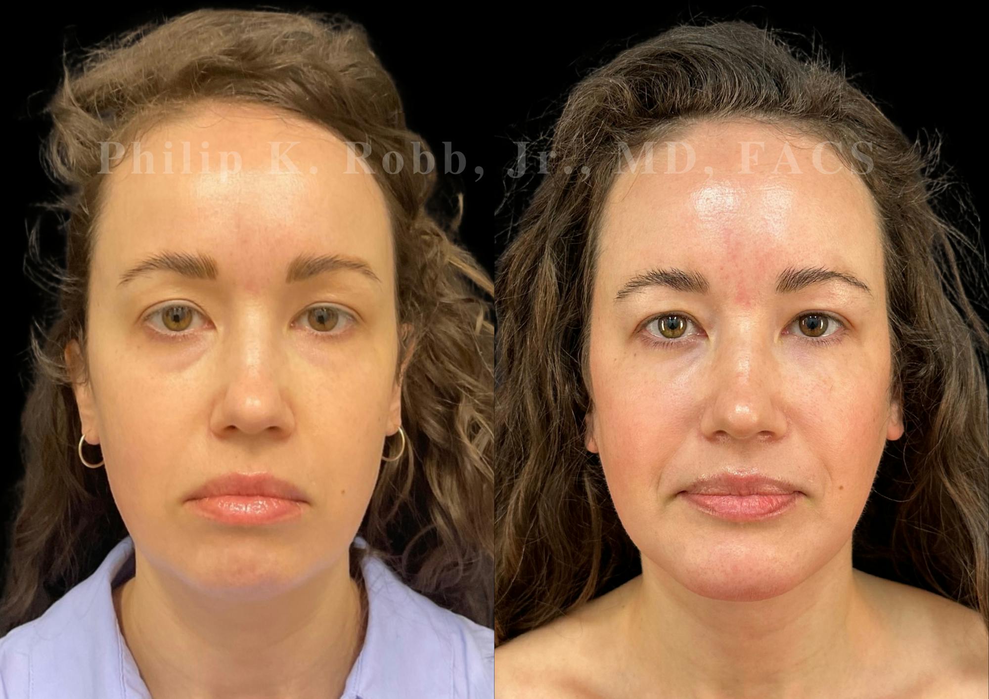 Chin Augmentation Before & After Gallery - Patient 311403 - Image 4