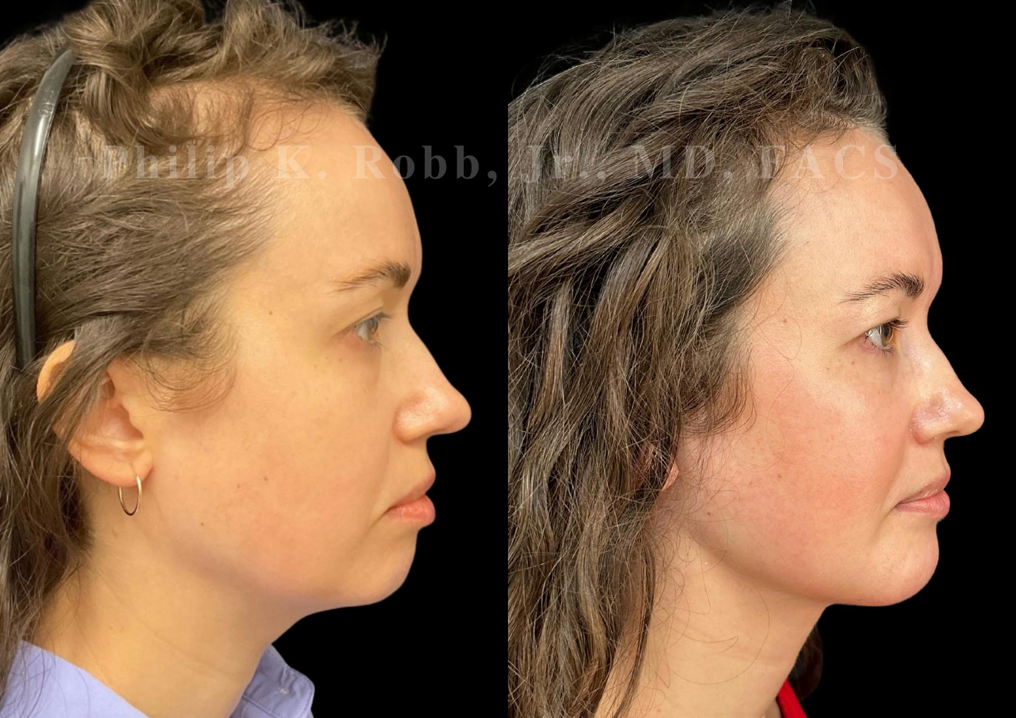 Chin Augmentation Before & After Gallery - Patient 311403 - Image 6