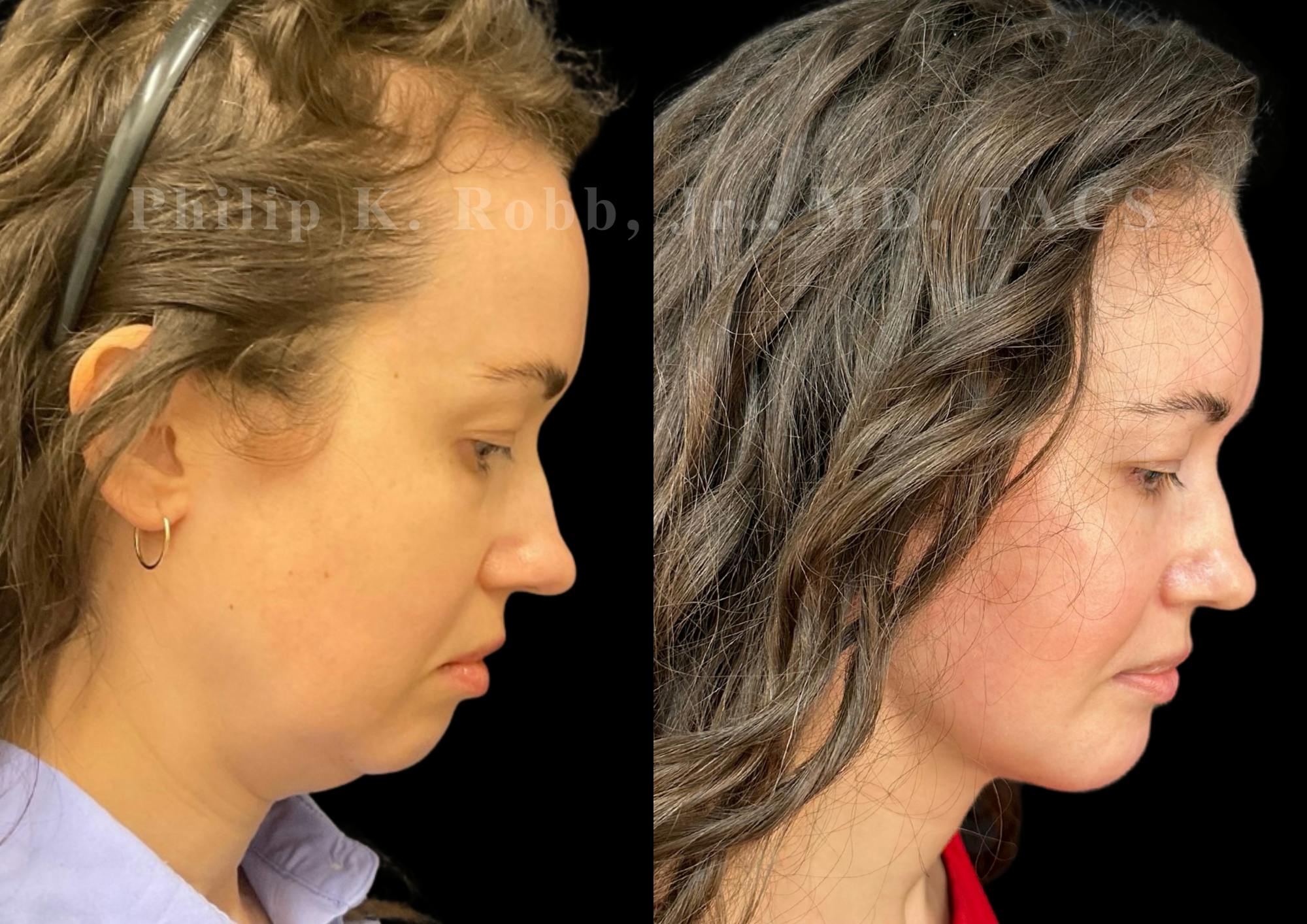 Chin Augmentation Before & After Gallery - Patient 311403 - Image 7