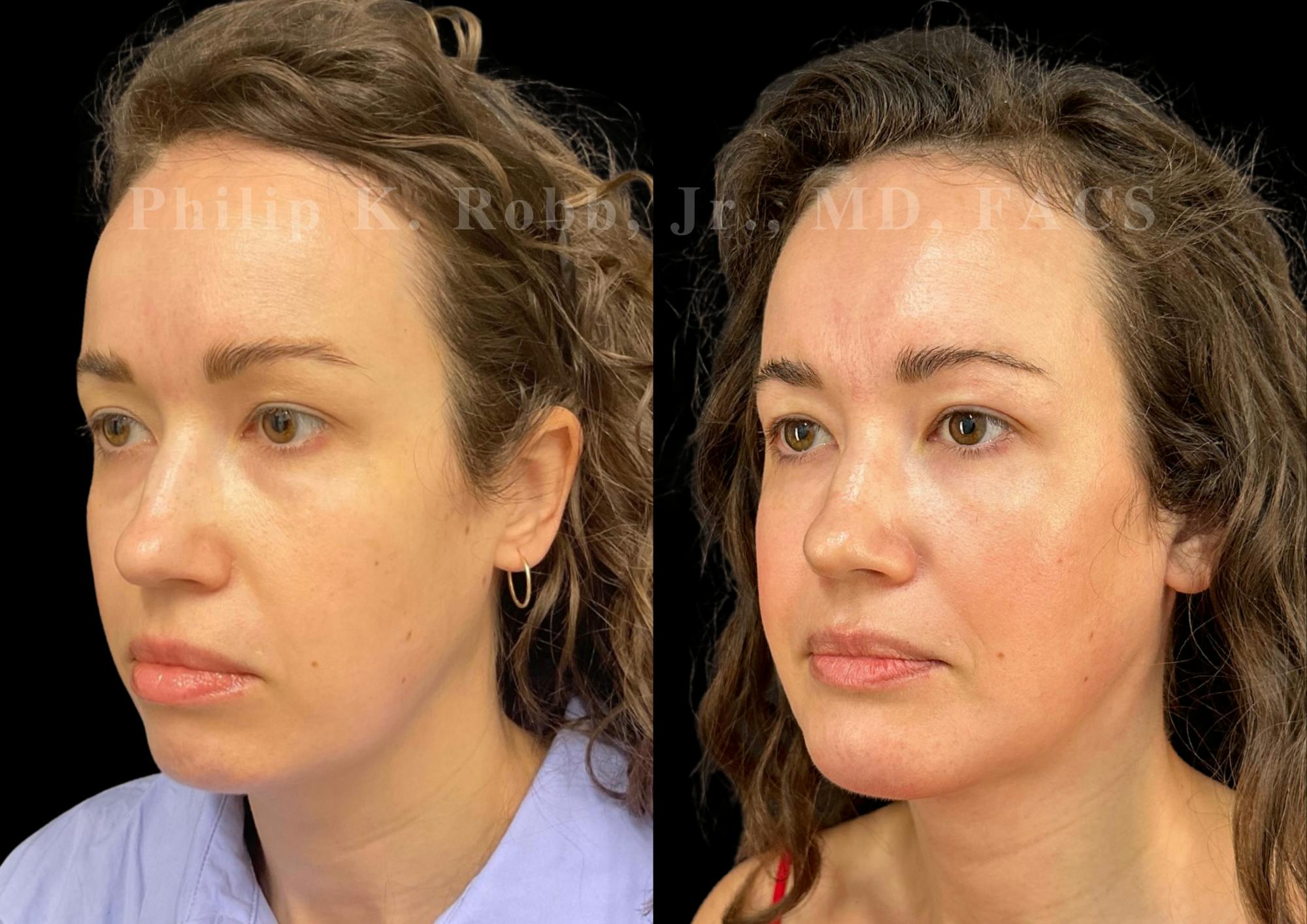 Chin Augmentation Before & After Gallery - Patient 311403 - Image 3