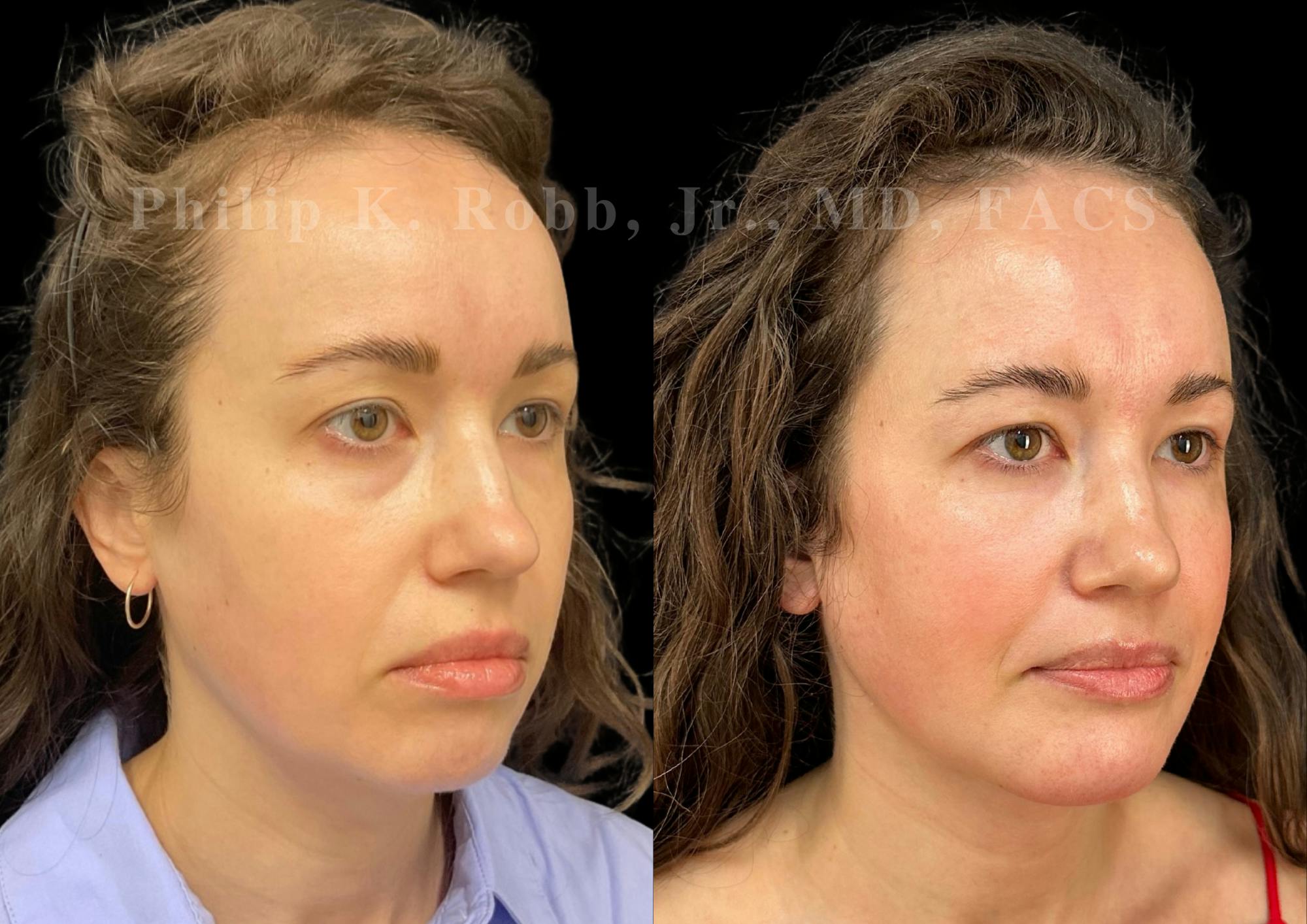 Chin Augmentation Before & After Gallery - Patient 311403 - Image 5