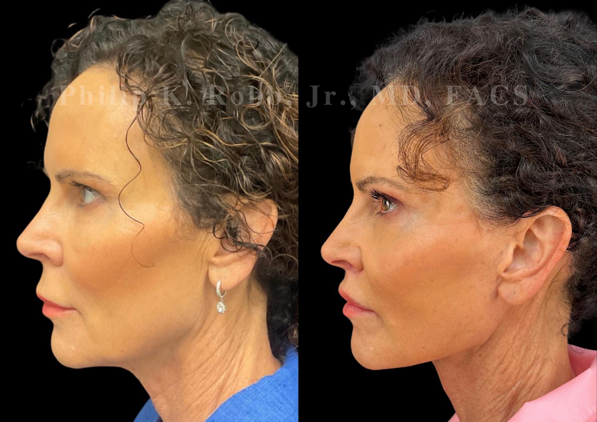 Lip Lift Before & After Gallery - Patient 144171 - Image 3
