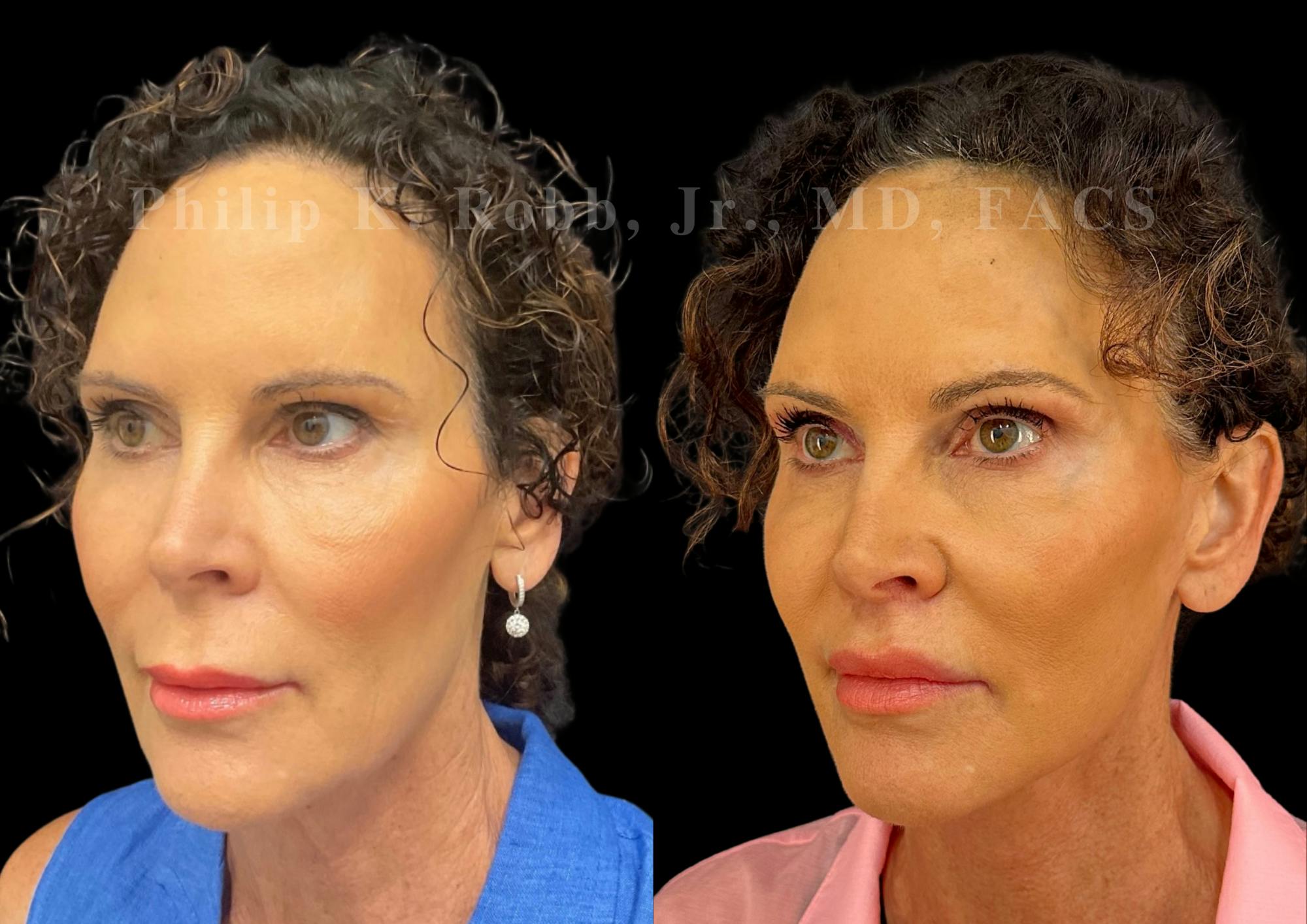 Lip Lift Before & After Gallery - Patient 144171 - Image 4