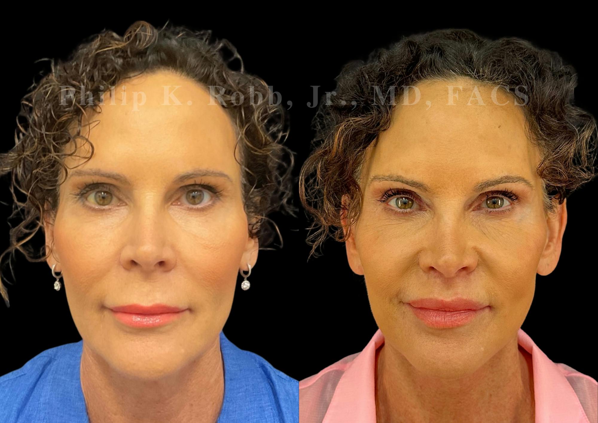 Lip Lift Before & After Gallery - Patient 144171 - Image 1