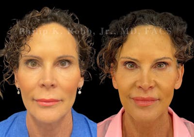 Lip Lift Before & After Gallery - Patient 144171 - Image 1