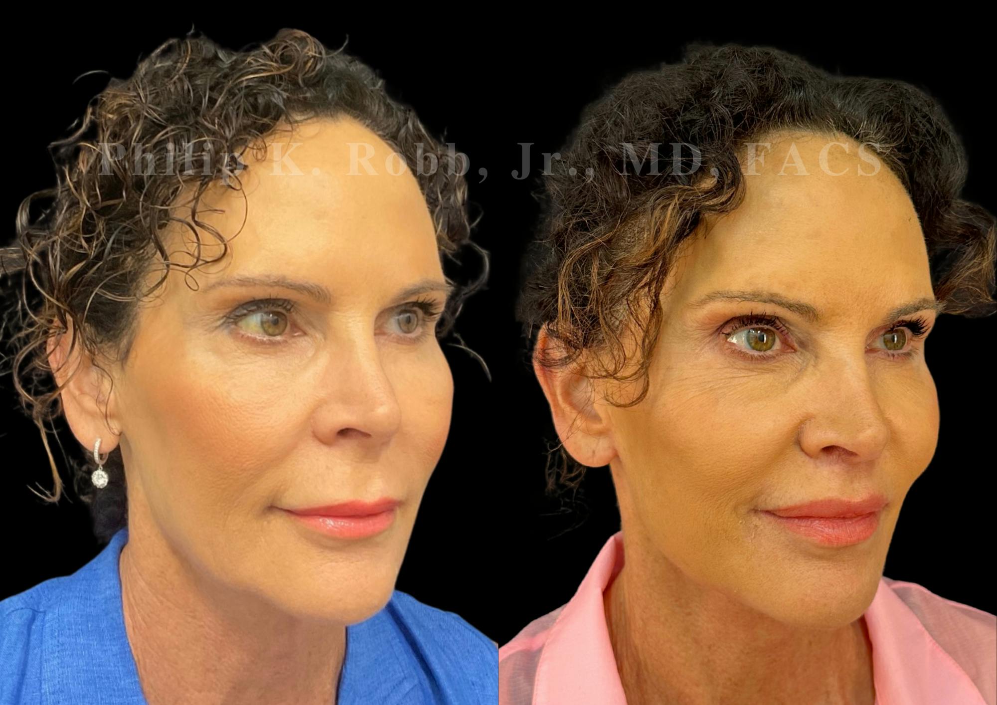 Lip Lift Before & After Gallery - Patient 144171 - Image 5