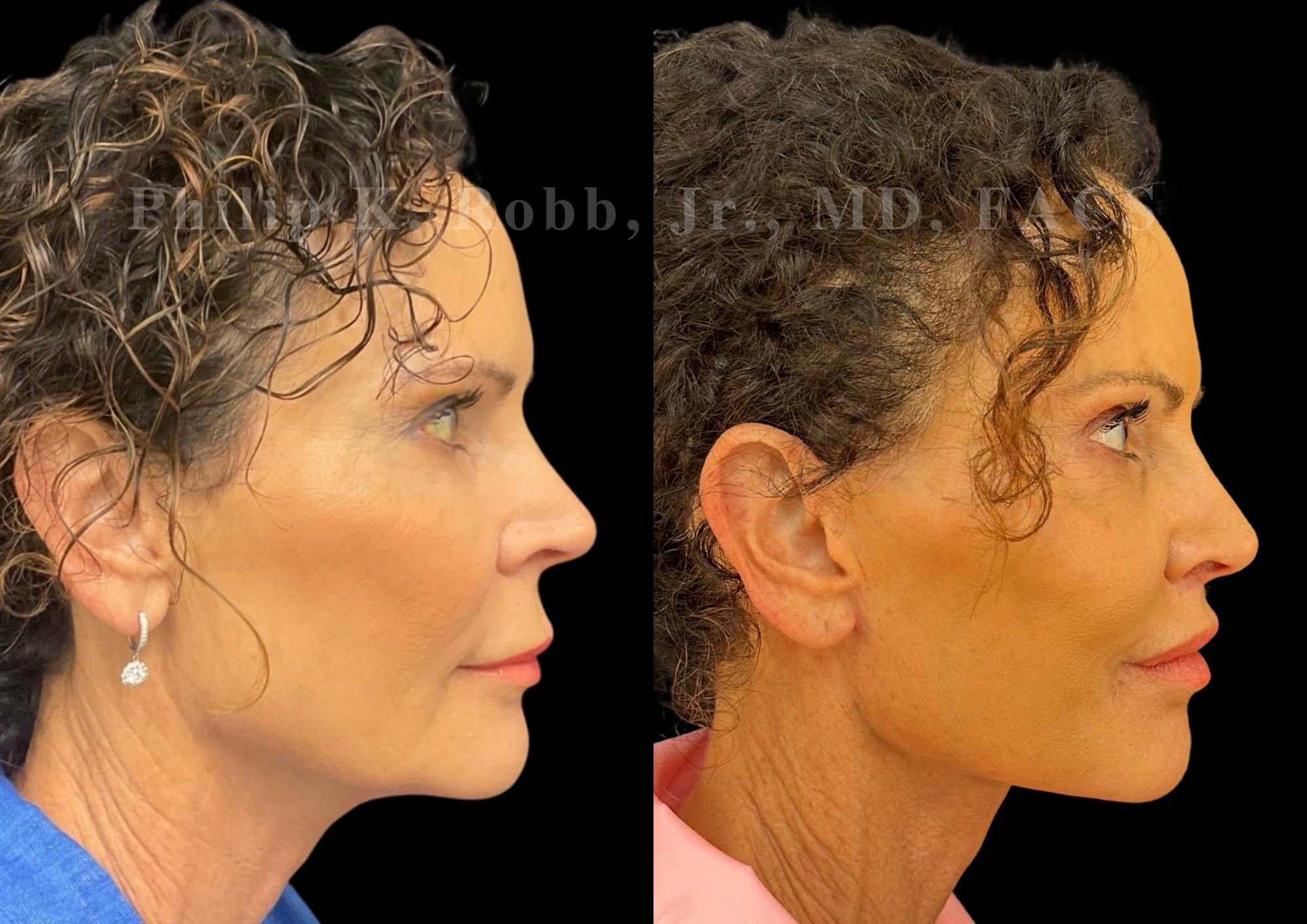 Lip Lift Before & After Gallery - Patient 144171 - Image 6