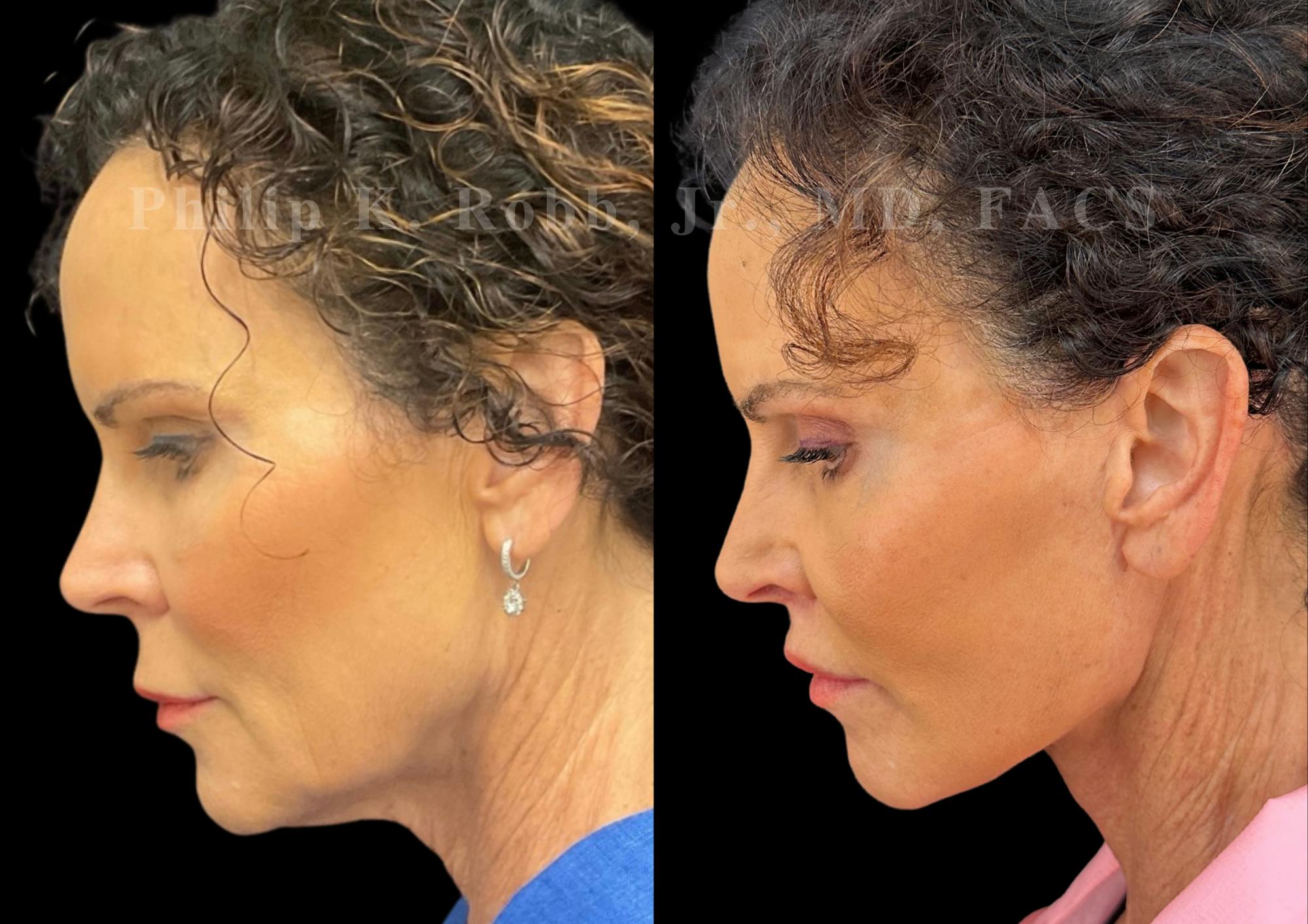 Lip Lift Before & After Gallery - Patient 144171 - Image 2