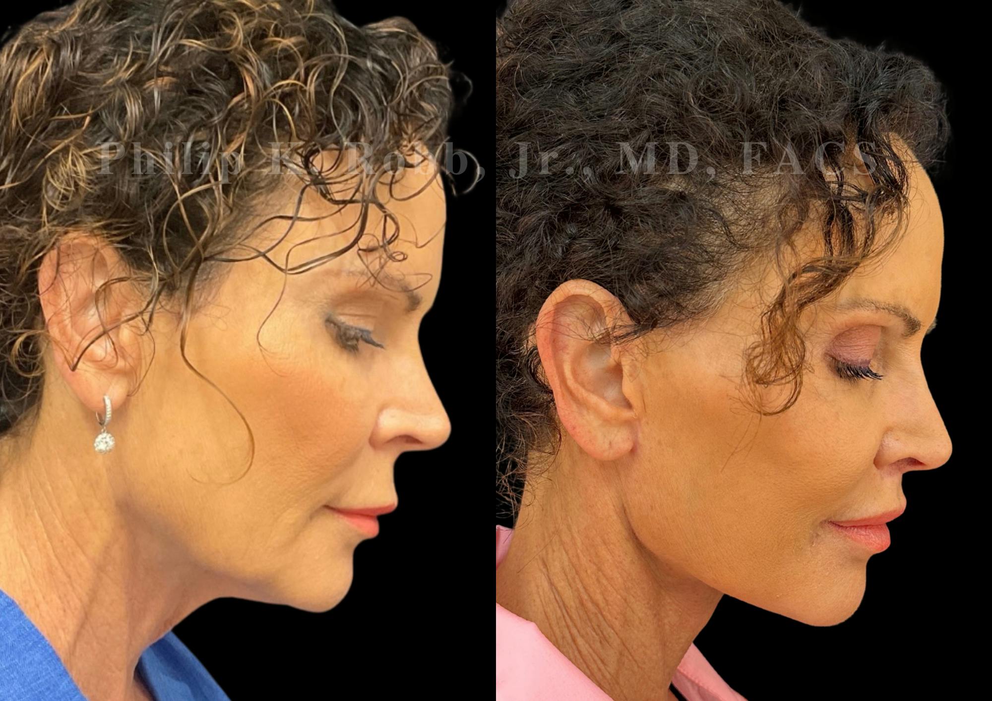 Lip Lift Before & After Gallery - Patient 144171 - Image 7