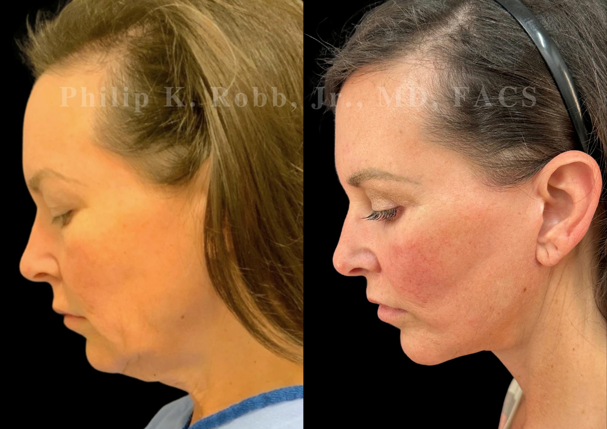 Lip Lift Before & After Gallery - Patient 796624 - Image 2