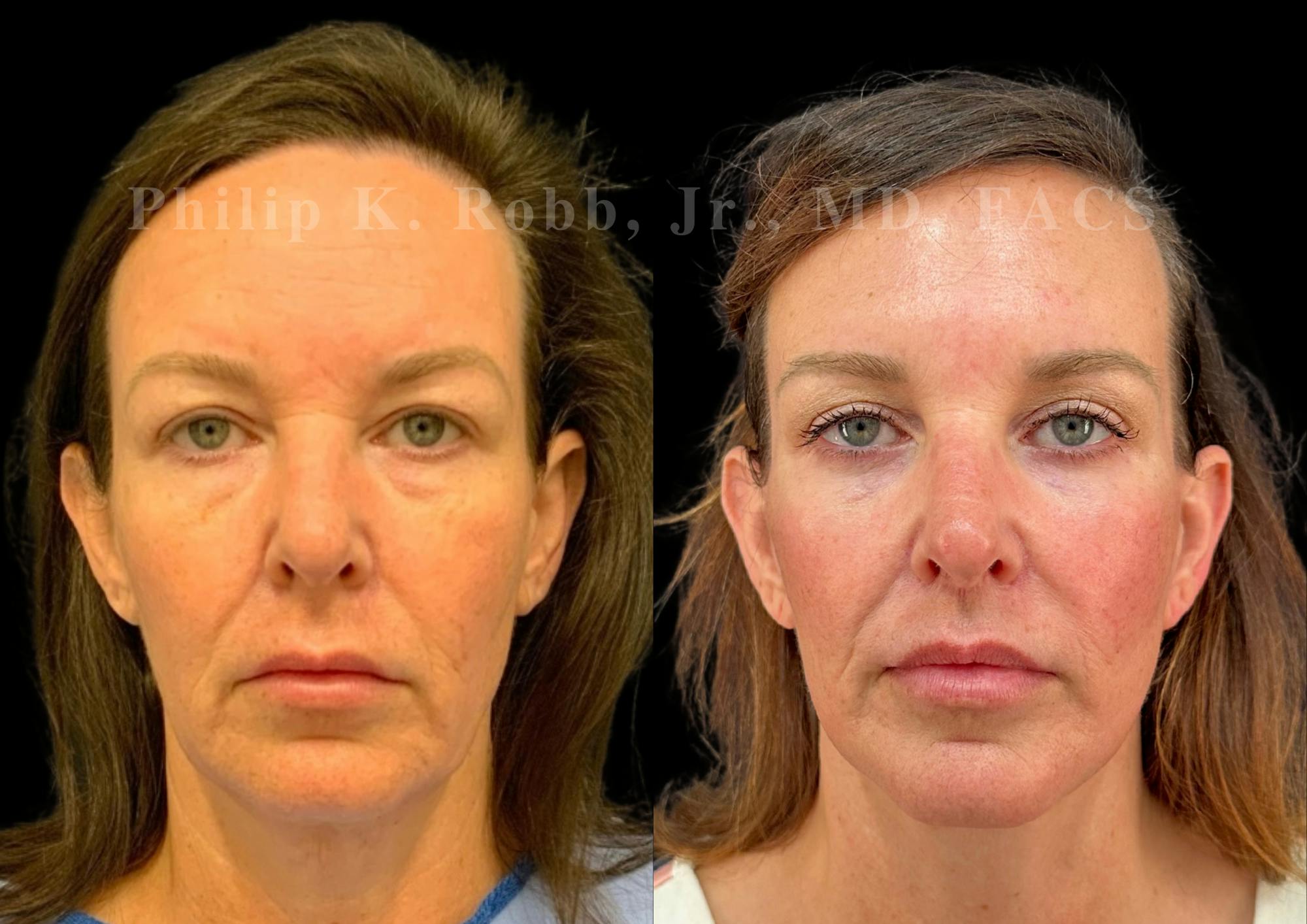 Lip Lift Before & After Gallery - Patient 796624 - Image 1