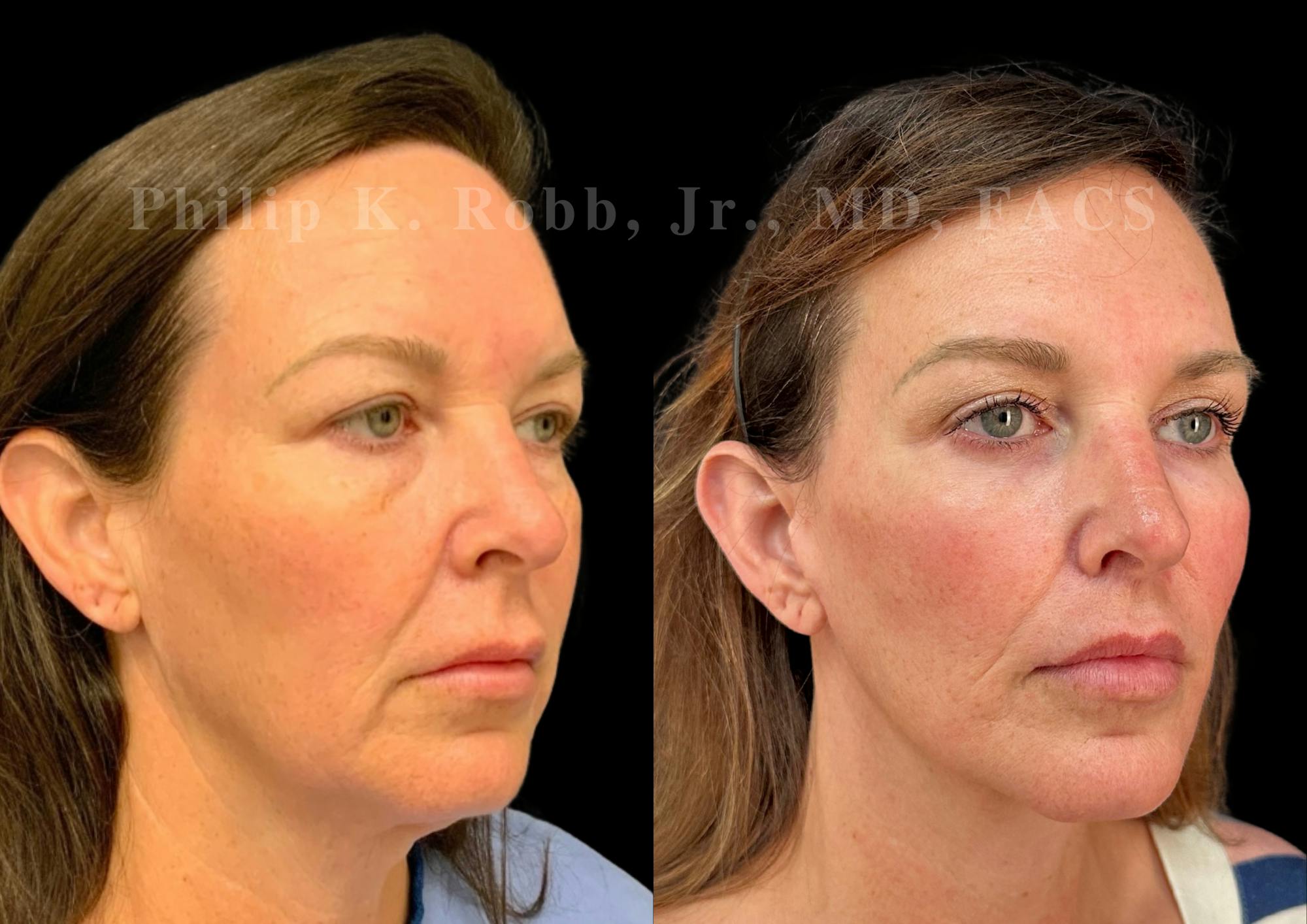 Lip Lift Before & After Gallery - Patient 796624 - Image 5
