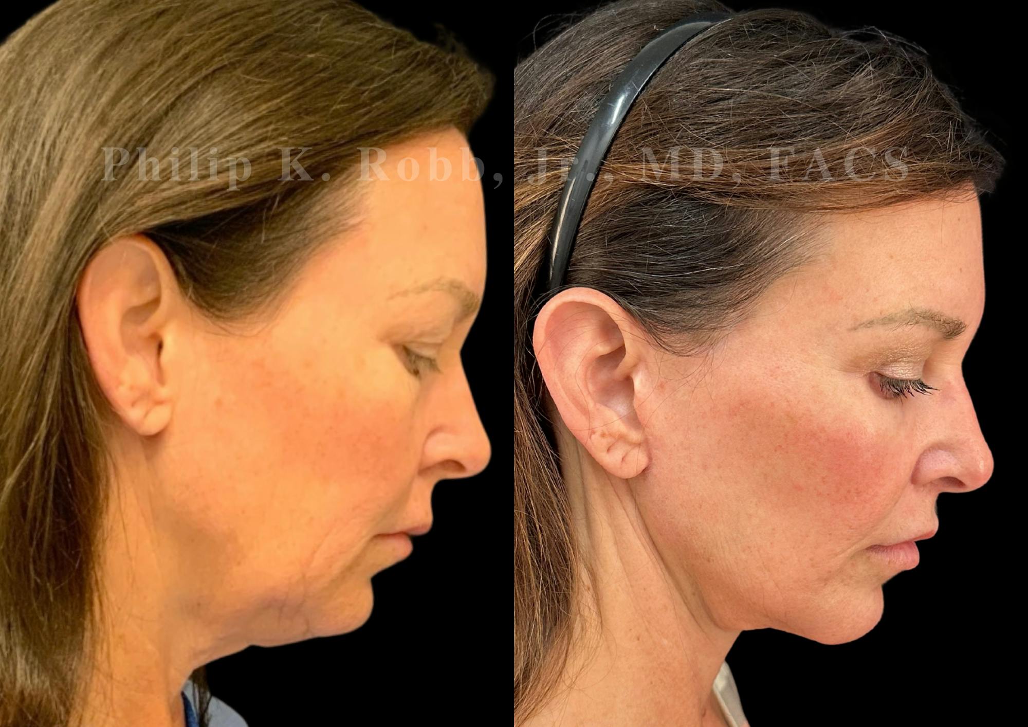 Lip Lift Before & After Gallery - Patient 796624 - Image 7