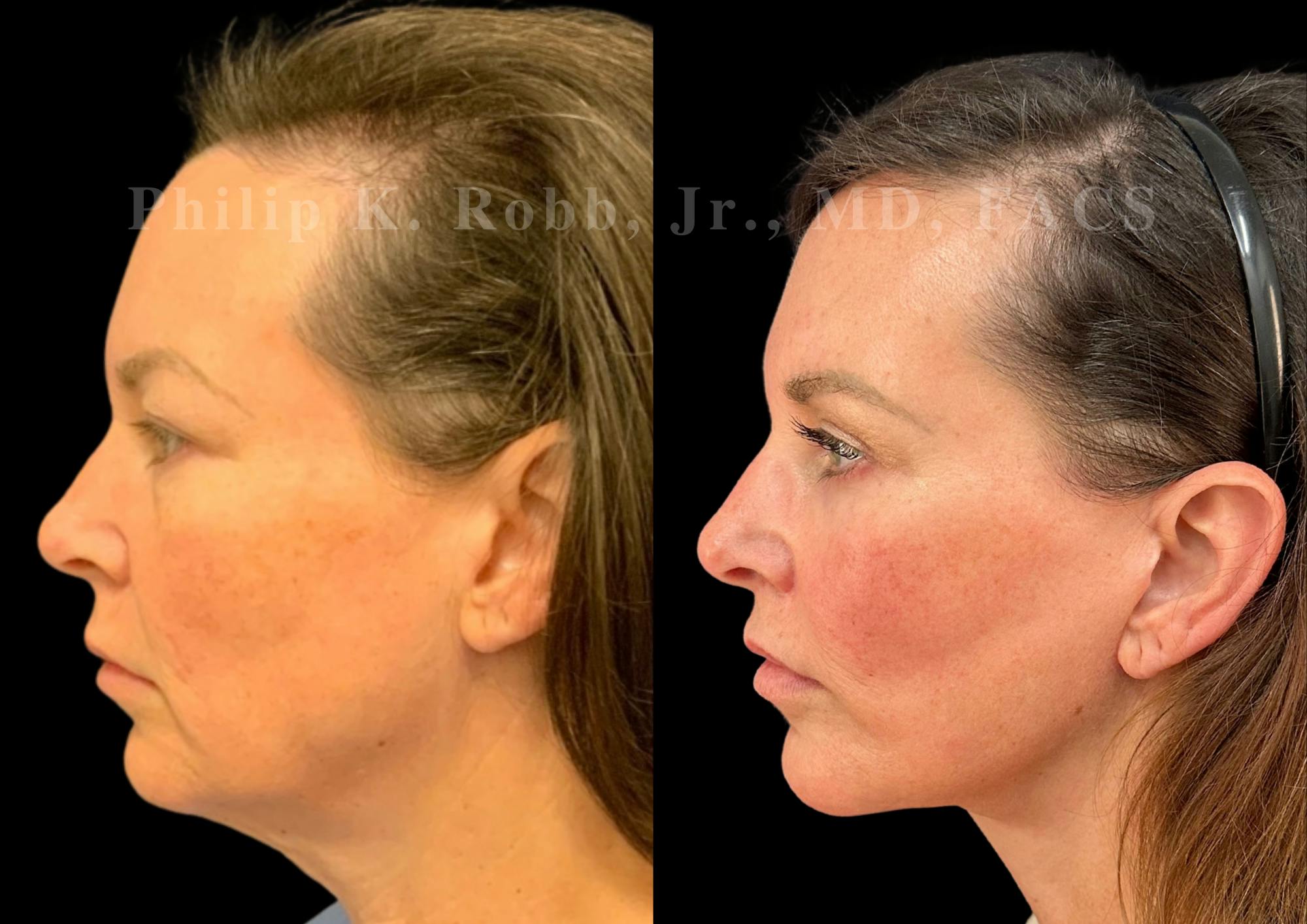 Lip Lift Before & After Gallery - Patient 796624 - Image 3