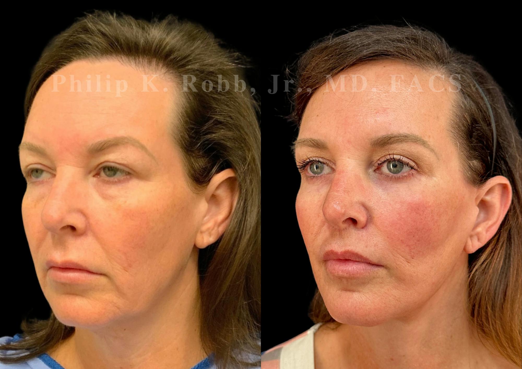 Lip Lift Before & After Gallery - Patient 796624 - Image 4