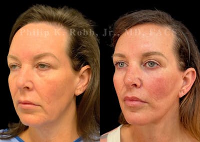 Facelift Before & After Gallery - Patient 250790 - Image 1