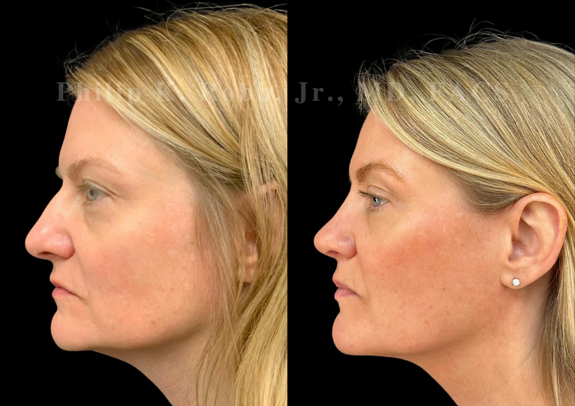 Ultrasonic Rhinoplasty Before & After Gallery - Patient 283374 - Image 5