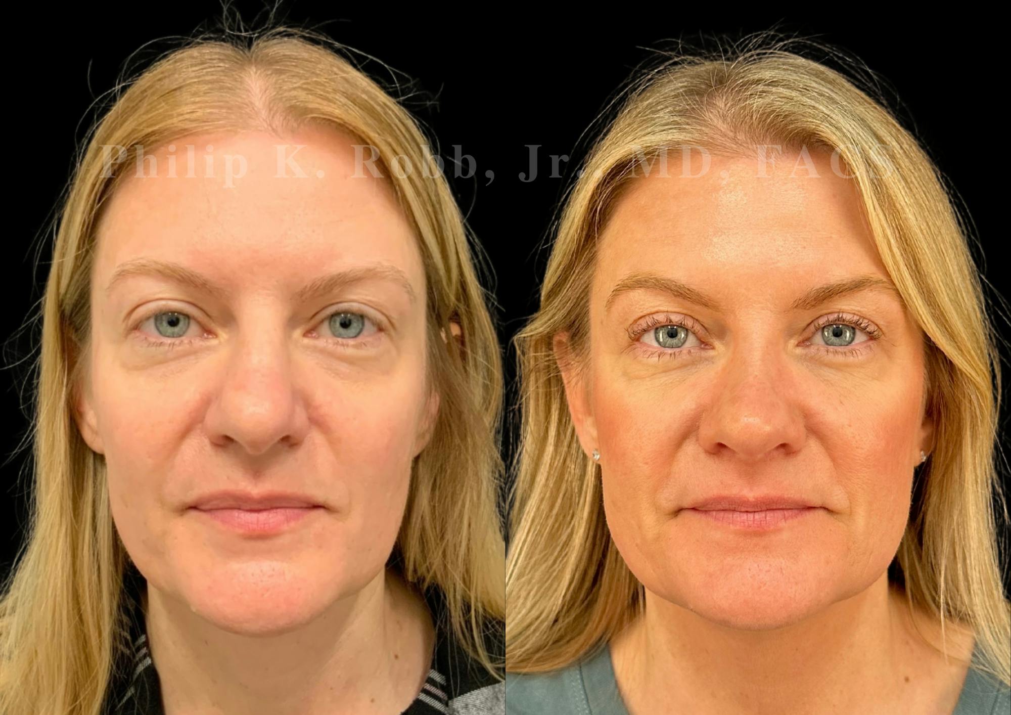 Ultrasonic Rhinoplasty Before & After Gallery - Patient 283374 - Image 3