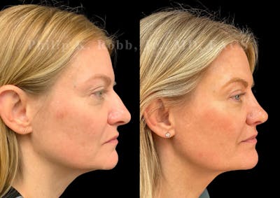 Ultrasonic Rhinoplasty Before & After Gallery - Patient 283374 - Image 1