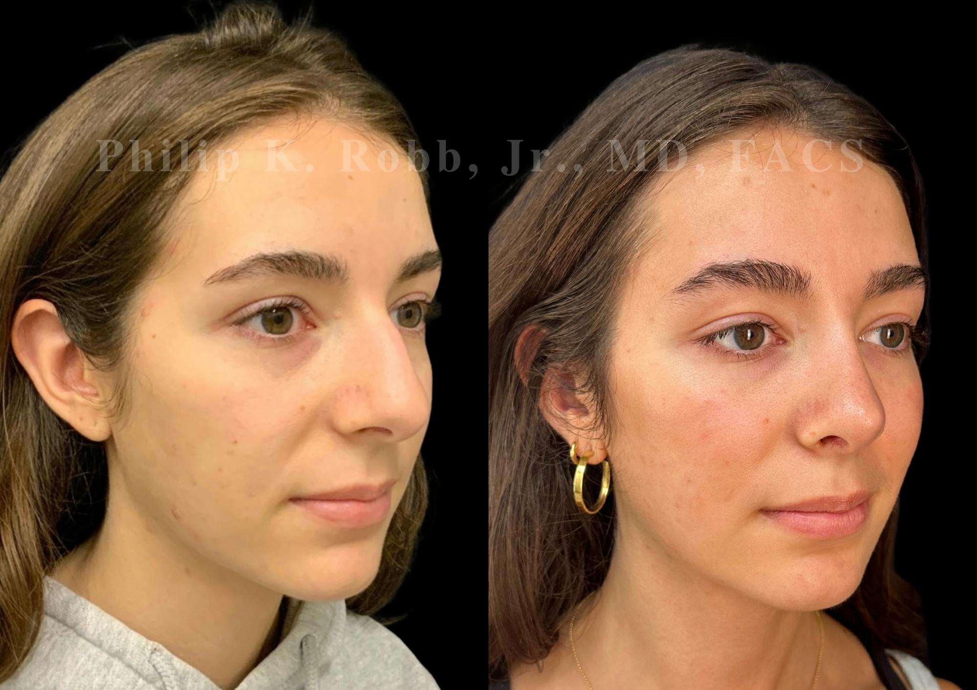 Ultrasonic Rhinoplasty Before & After Gallery - Patient 356035 - Image 2