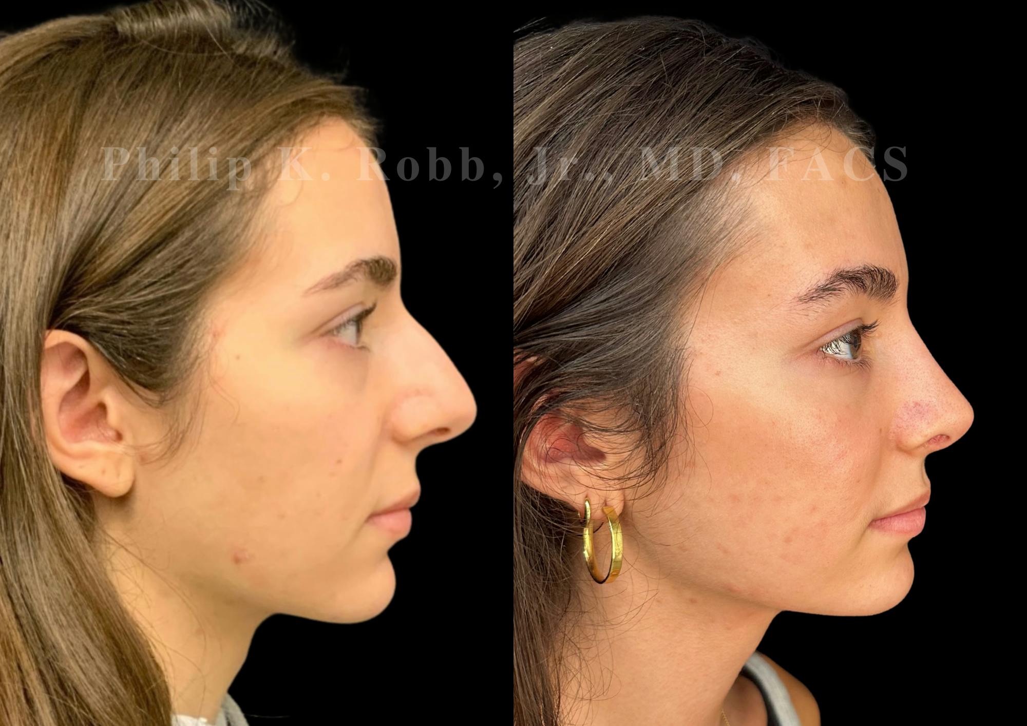 Ultrasonic Rhinoplasty Before & After Gallery - Patient 356035 - Image 1